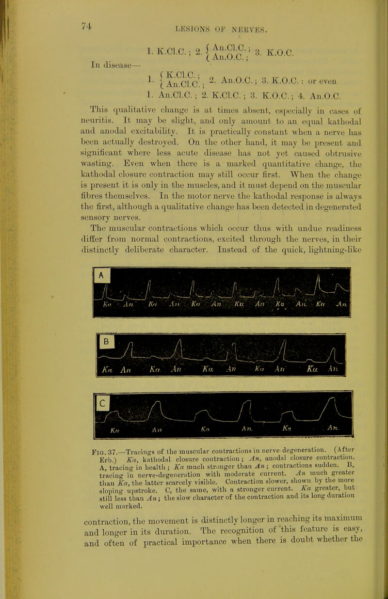 1. K.Cl.C. In disease o (An.Cl.C. *' ( An.O.C. 3. K.O.C. 1. 1. ( K.Cl.C.; \ An.Cl.C. ; An.Cl.C. ; 2, 2. An.O.C.; 3. K.O.C. : or even K.Cl.C.; 3. K.O.C.; 4. An.O.C. This qualitative change is at times absent, especially in cases of neuritis. It may be slight, and only amount to an equal kathodal and anodal excitability. It is practically constant when a nerve has been actually destroyed. On the other hand, it may be present and significant where less acute disease has not yet caused obtrusive wasting. Even when there is a marked quantitative change, the kathodal closure contraction may still occur first. When the change is present it is only in the muscles, and it must depend on the muscular fibres themselves. In the motor nerve the kathodal response is always the first, although a qualitative change has been detected in degenerated sensory nerves. The muscular contractions which occur thus with undue readiness differ from normal contractions, excited through the nerves, in their distinctly deliberate character. Instead of the quick, lightning-like Kit An K't An Kn An Ka An Ka Ail Krt An. Fig. 37.—Tracings of the muscular contractions in nerve-degeneratiou. (After Erb.) Ka, kathodal closure contraction; An, anodal closure contraction. A, tracing in health ; Ka much stronger than An; contractions sudden. B, tracing iu nerve-degeneration with moderate current. An much greater than Ka, the latter scarcely visible. Contraction slower, shown by the more sloping upstroke. C, the same, with a stronger current. Ka greater, but still less than An; the slow character of the contraction and its long duration well marked. contraction, the movement is distinctly longer in reaching its maximum and longer in its duration. The recognition of this feature is easy, and often of practical importance when there is doubt whether the