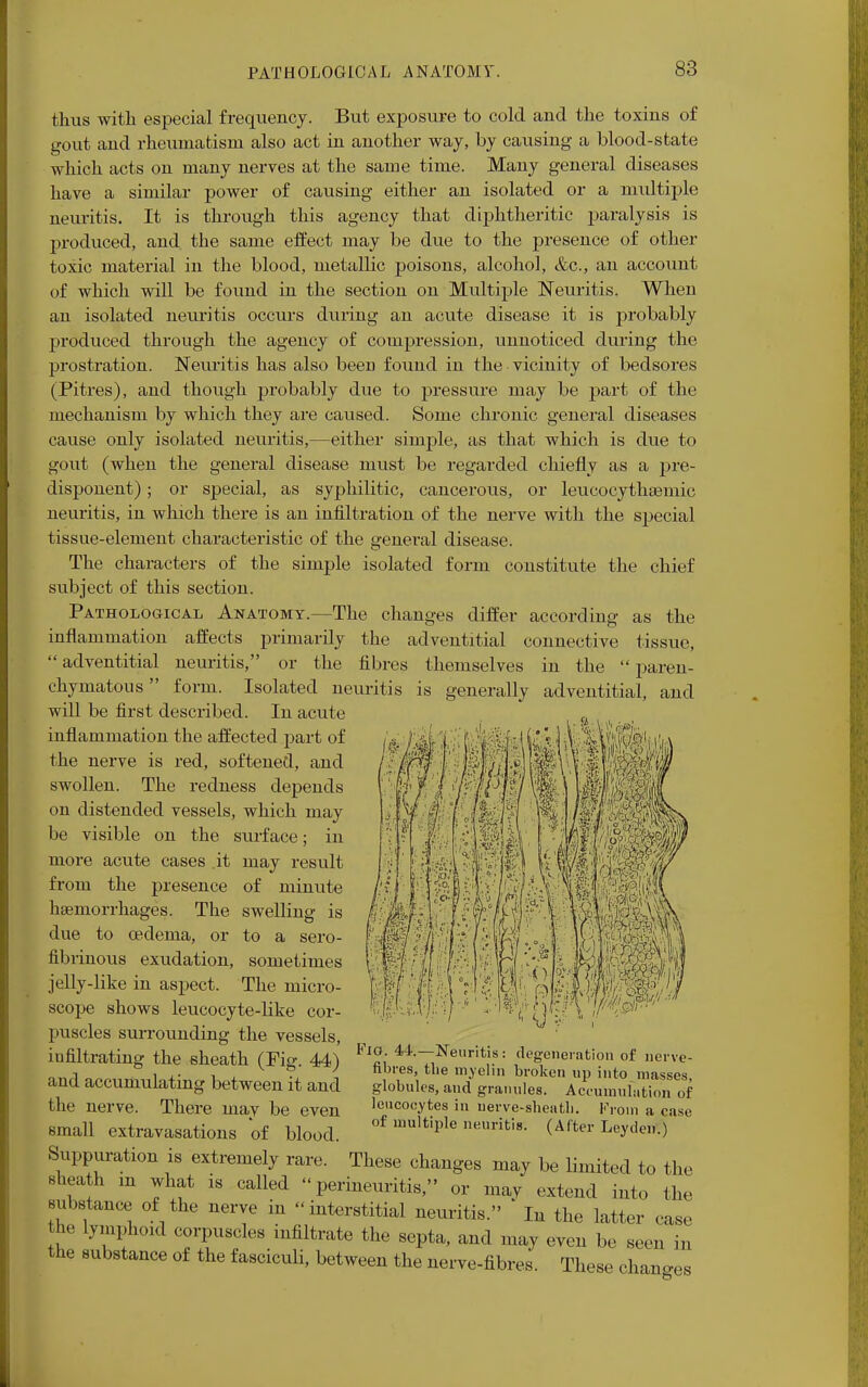 PATHOLOGICAL ANATOMY. thus with especial frequency. But exposure to cold and the toxins of gout and rheumatism also act in another way, by causing a blood-state which acts on many nerves at the same time. Many general diseases have a similar power of causing either an isolated or a multiple neuritis. It is through this agency that diphtheritic paralysis is produced, and. the same effect may be due to the presence of other toxic material in the blood, metallic poisons, alcohol, &c, an account of which will be found in the section on Multiple Neuritis. When an isolated neuritis occurs during an acute disease it is probably produced through the agency of compression, unnoticed during the prostration. Neuritis has also been found in the vicinity of bedsores (Pitres), and though probably due to pressure may be part of the mechanism by which they are caused. Some chronic general diseases cause only isolated neuritis,—either simple, as that which is due to gout (when the general disease must be regarded chiefly as a pre- disponent); or special, as syphilitic, cancerous, or leueocythgemic neuritis, in which there is an infiltration of the nerve with the special tissue-element characteristic of the general disease. The characters of the simple isolated form constitute the chief subject of this section. Pathological Anatomy.—The changes differ according as the inflammation affects primarily the adventitial connective tissue, adventitial neuritis, or the fibres themselves in the paren- chymatous form. Isolated neuritis is generally adventitial, and will be first described. In acute inflammation the affected part of the nerve is red, softened, and swollen. The redness depends on distended vessels, which may be visible on the surface; in more acute cases .it may result from the presence of minute haemorrhages. The swelling is due to oedema, or to a sero- fibrinous exudation, sometimes jelly-like in aspect. The micro- scope shows leucocyte-like cor- puscles surrounding the vessels, infiltrating the sheath (Fig. 44) Vlfi 4Neritj?: degeneration of nerve- t , ,. v ? 7 nores, the myelin broken up into massps globules, and granules. Accumulation of leucocytes in uerve-sheatli. From a case of multiple neuritis. (After Leyden.) Suppuration is extremely rare. These changes may be limited to the sheath m what is called perineuritis, or may extend into the substance of the nerve in interstitial neuritis. * In the latter case the lymphoid corpuscles infiltrate the septa, and may even be seen in the substance of the fasciculi, between the nerve-fibres. These changes W and accumulating between it and the nerve. There may be even small extravasations of blood.