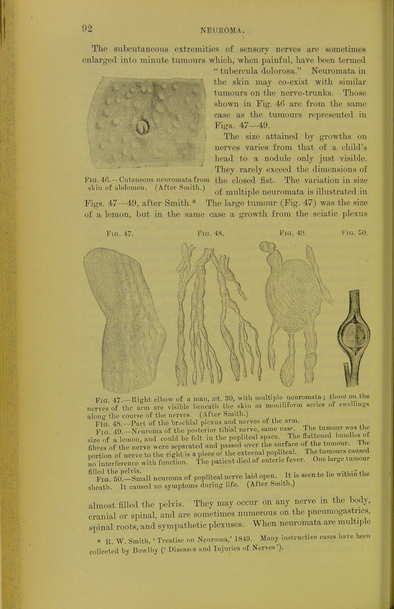The subcutaneous extremities of sensory nerves are sometimes enlarged into minute tumours which, when painful, have been termed  tubercula dolorosa. Neuromata in the skin may co-exist with similar tumours on the nerve-trunks. Those shown in Fig. 46 are from the same case as the tumours represented in Figs. 47—49. The size attained by growths on nerves varies from that of a child's head to a nodule only just visible. They rarely exceed the dimensions of the closed fist. The variation in size of multiple neuromata is illustrated in The large tumour (Fig. 47) was the size Fig. 46. — Cutaneous neuromata from skin of abdomen. (After Smith.) Figs. 47—49, after Smith.* of a lemon, but in the same case a growth from the sciatic plexus Fig. 47. Fro. 48. Fro. 49. ftp m m-K Fig. 50. • w y Fig 47 —Right elbow of a man, set. 30, with multiple neuromata; those on the nerves of the arm are visible beneath the skin as moniliform series of swellings alone the course of the nerves. (After Smith.) Yta 48.—Part of the brachial plexus and nerves of the arm. PlG 49.-Neuroma of the posterior tibial nerve, same case Die tumour was the size of a lemon, and could be felt in the popliteal space. The flattened bundles ot fibres of the nerve were separated and passed over the surface of the tumou,. 1 he portion of nerve to the right is a piece of the external popliteal. The tumours caused ^0 inteiSrence with function. The patient died of enteric fever. One large tumour 61 mtlo.-L,l\ neuroma of popliteal nerve laid open. It is seen to lie within the sheath. It caused no symptoms during life. (After Smith.) almost filled the pelvis. They may occur on any nerve in the body, cranial or spinal, and are sometimes numerous on the pneumogastrics, spinal roots, and sympathetic plexuses. When neuromata are multiple * It. W. Smith, ' Treatise on Neuroma,' 1849. Many instructive cases have been collected by Bowlby (' Diseases and Injuries of Nerves').