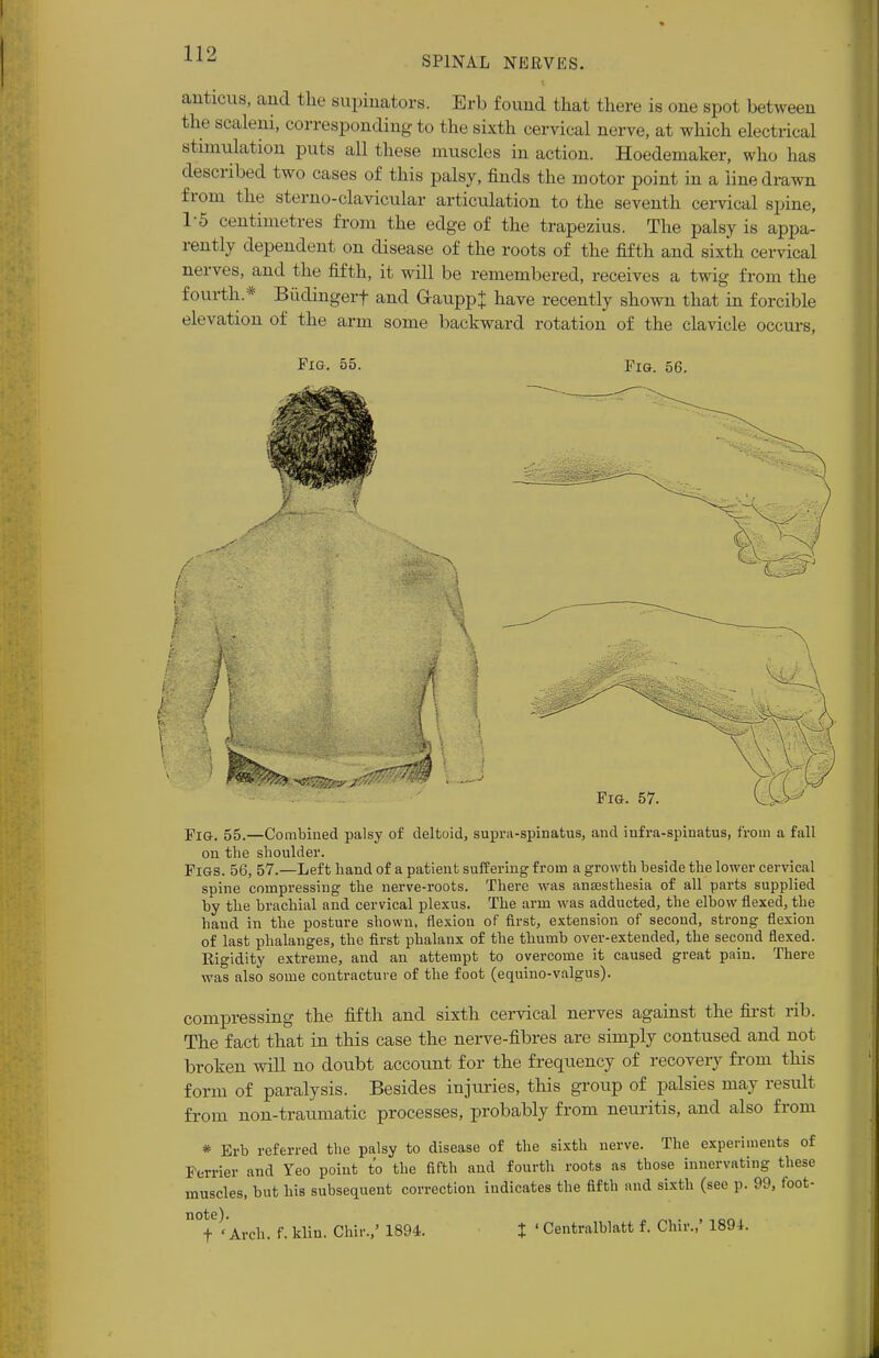 SPINAL NERVES. anticus, and the supinators. Erb found that there is one spot between the scaleni, corresponding to the sixth cervical nerve, at which electrical stimulation puts all these muscles in action. Hoedemaker, who has described two cases of this palsy, finds the motor point in a line drawn from the sterno-clavicular articulation to the seventh cervical spine, 1-5 centimetres from the edge of the trapezius. The palsy is appa- rently dependent on disease of the roots of the fifth and sixth cervical nerves, and the fifth, it will be remembered, receives a twig from the fourth.* Biidingerf and Gaupp+ have recently shown that in forcible elevation of the arm some backward rotation of the clavicle occurs, Fig. 55. Fig. 56. i f Fig. 57. FlG. 55.—Combined palsy of deltoid, supra-spinatus, and iufra-spiuatus, from a fall on the shoulder. Figs. 56, 57.—Left hand of a patient suffering from a growth beside the lower cervical spine compressing the nerve-roots. There was anaesthesia of all parts supplied by the brachial and cervical plexus. The arm was adducted, the elbow flexed, the hand in the posture shown, flexion of first, extension of second, strong flexion of last phalanges, the first phalanx of the thumb over-extended, the second flexed. Kigidity extreme, and an attempt to overcome it caused great pain. There was also some contracture of the foot (equino-valgus). compressing the fifth and sixth cervical nerves against the first rib. The fact that in this case the nerve-fibres are simply contused and not broken will no doubt account for the frequency of recovery from this form of paralysis. Besides injuries, this group of palsies may result from non-traumatic processes, probably from neuritis, and also from * Erb referred the palsy to disease of the sixth nerve. The experiments of Ferrier and Yeo point to the fifth and fourth roots as those innervating these muscles, but bis subsequent correction indicates the fifth and sixth (see p. 99, foot- Arch, f. klin. Chir.,' 1894. t ' Centralblatt f. Chir.,' 1894.