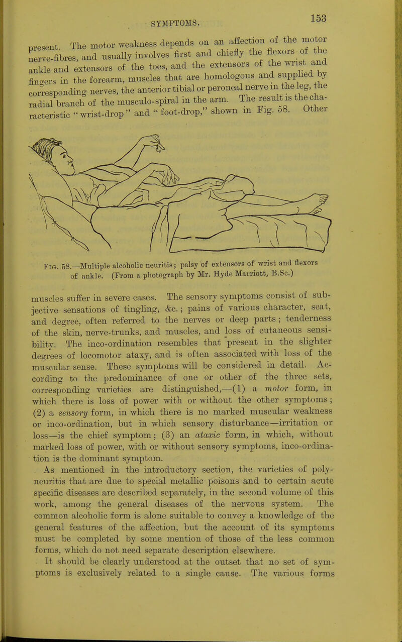 SYMPTOMS. nreseixt The motor weakness depends on an affection of the motor nerve-fibres, and usually involves first and chiefly the flexors of the ^ !nd extensors of the toes, and the extensors of the wn. and fibers in the forearm, muscles that are homologous and supplied by corresponding nerves, the anterior tibial or peroneal nerve m the leg, the radial branch of the nmsculo-spiral in the arm. The result is the cha- racteristic wrist-drop and < foot-drop, shown m Fig. 58. Other Fig. 58.—Multiple alcoholic neuritis; palsy of extensors of wrist and flexors of ankle. (From a photograph by Mr. Hyde Marriott, B.Sc.) muscles suffer in severe cases. The sensory symptoms consist of sub- jective sensations of tingling, &c.; pains of various character, seat, and degree, often referred to the nerves or deep parts; tenderness of the skin, nerve-trunks, and muscles, and loss of cutaneous sensi- bility. The inco-ordination resembles that present in the slighter degrees of locomotor ataxy, and is often associated with loss of the muscular sense. These symptoms will be considered in detail. Ac- cording to the predominance of one or other of the three sets, corresponding varieties are distinguished,—(1) a motor form, in which there is loss of power with or without the other symptoms; (2) a sensory form, in which there is no marked muscular weakness or inco-ordination, but in which sensory disturbance—irritation or loss—is the chief symptom; (3) an ataxic form, in which, without marked loss of power, with or without sensory symptoms, inco-ordina- tion is the dominant symptom. As mentioned in the introductory section, the varieties of poly- neuritis that are due to special metallic poisons and to certain acute specific diseases are described separately, in the second volume of this work, among the general diseases of the nervous system. The common alcoholic form is alone suitable to convey a knowledge of the general features of the affection, but the account of its symptoms must be completed by some mention of those of the less common forms, which do not need separate description elsewhere. It should be clearly understood at the outset that no set of sym- ptoms is exclusively related to a single cause. The various forms