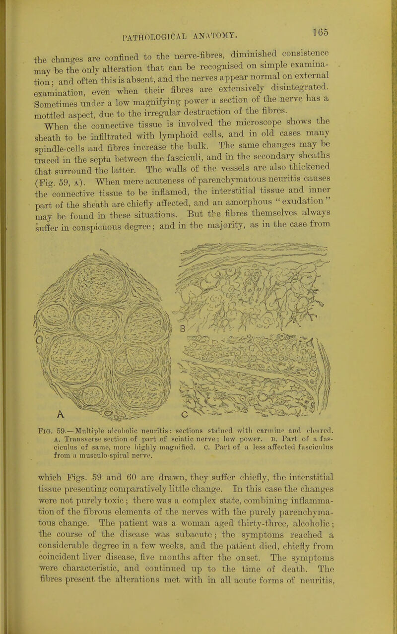 the chano-es are confined to the nerve-fibres, diminished consistence may be the only alteration that can be recognised on simple examina- tion • and often this is absent, and the nerves appear normal on external examination, even when their fibres are extensively disintegrated. Sometimes under a low magnifying power a section of the nerve has a mottled aspect, due to the irregular destruction of the fibres. When the connective tissue is involved the microscope shows the sheath to be infiltrated with lymphoid cells, and in old cases many spindle-cells and fibres increase the bulk. The same changes may be traced in the septa between the fasciculi, and in the secondary sheaths that surround the latter. The walls of the vessels are also thickened (Fig. 59, a). When mere acuteness of parenchymatous neuritis causes the°connective tissue to be inflamed, the interstitial tissue and inner part of the sheath are chiefly affected, and an amorphous exudation may be found in these situations. But the fibres themselves always suffer in conspicuous degree; and in the majority, as in the case from Fig. 59.— Multiple aleoliolic neuritis: sections stained with carmine and cleared. A. Transverse section of part of sciatic nerve; low power. E. Part of a fas- ciculus of same, more highly magnified. C. Part of a less affected fasciculus from a musculo-spiral nerve. which Figs. 59 and 60 are drawn, they suffer chiefly, the interstitial tissue presenting comparatively little change. In this case the changes were not purely toxic ; there was a complex state, combining inflamma- tion of the fibrous elements of the nerves with the purely parenchyma- tous change. The patient was a woman aged thirty-three, alcoholic; the course of the disease was subacute; the symptoms reached a considerable degree in a few weeks, and the patient died, chiefly from coincident liver disease, five months after the onset. The symptoms were characteristic, and continued up to the time of death. The fibres present the alterations met, with in allaculc forms of neuritis,