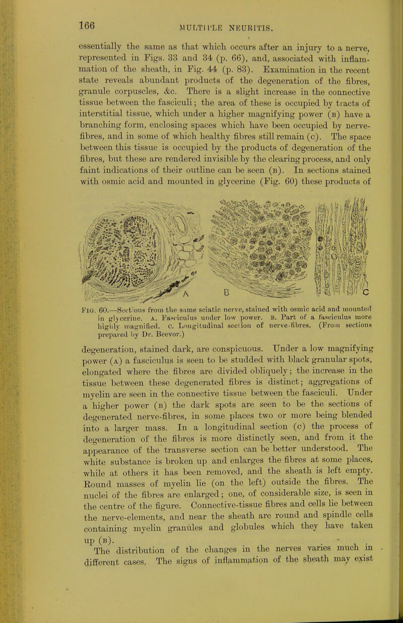 essentially the same as that which occurs after an injury to a nerve, represented in Figs. 33 and 34 (p. 66), and, associated with inflam- mation of the sheath, in Fig. 44 (p. 83). Examination in the recent state reveals abundant products of the degeneration of the fibres, granule corpuscles, &c. There is a slight increase in the connective tissue between the fasciculi; the area of these is occupied by tracts of interstitial tissue, which under a higher magnifying power (b) have a branching form, enclosing spaces which have been occupied by nerve- fibres, and in some of which healthy fibres still remain (c). The space between this tissue is occupied by the products of degeneration of the fibres, but these are rendered invisible by the clearing process, and only faint indications of their outline can be seen (b). In sections stained with osmic acid and mounted in glycerine (Fig. 60) these products of KlG. 60.—Sections from the same sciatic, nerve, stained with osmic acid and mounted in glycerine, a. Fasciculus under low power. B. Part of a fasciculus more highly magnified, c. Longitudinal seel ion of nerve-fibres. (From sections prepared by Dr. Beevor.) degeneration, stained dark, are conspicuous. Under a low magnifying power (a) a fasciculus is seen to be studded with black granular spots, elongated where the fibres are divided obliquely; the increase in the tissue between these degenerated fibres is distinct; aggregations of myelin are seen in the connective tissue between the fasciculi. Under a higher power (b) the dark spots are seen to be the sections of degenerated nerve-fibres, in some places two or more being blended into a larger mass. In a longitudinal section (c) the process of degeneration of the fibres is more distinctly seen, and from it the appearance of the transverse section can be better understood. The white substance is broken up and enlarges the fibres at some places, while at others it has been removed, and the sheath is left empty. Eound masses of myelin lie (on the left) outside the fibres. The nuclei of the fibres are enlarged; one, of considerable size, is seen in the centre of the figure. Connective-tissue fibres and cells lie between the nerve-elements, and near the sheath are round and spindle cells containing myelin granules and globules which they have taken up (b). • The distribution of the changes in the nerves varies much in different cases, The signs of inflammation of the sheath may exist