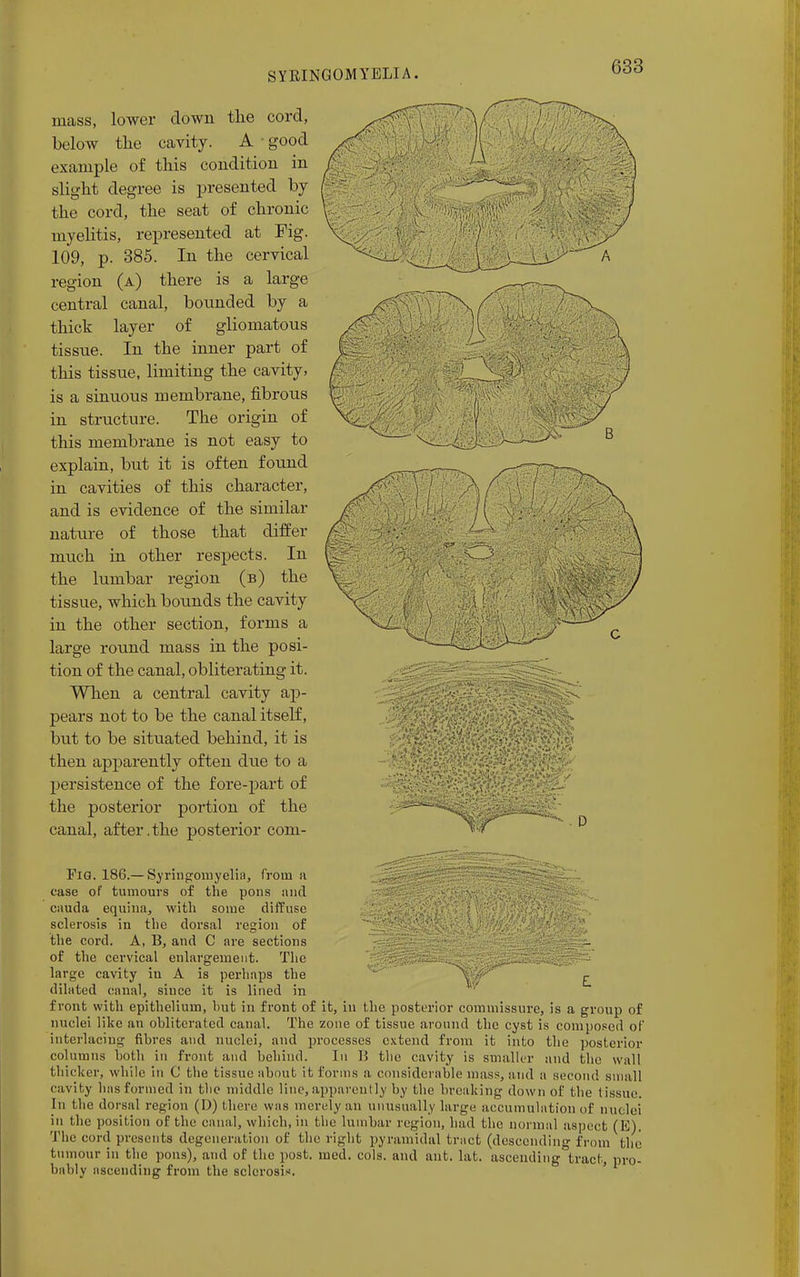 mass, lower down the cord, below the cavity. A ■ good example of this condition in slight degree is presented by the cord, the seat of chronic myelitis, represented at Fig. 109, p. 385. In the cervical region (a) there is a large central canal, bounded by a thick layer of gliomatous tissue. In the inner part of this tissue, limiting the cavity, is a sinuous membrane, fibrous in structure. The origin of this membrane is not easy to explain, but it is often found in cavities of this character, and is evidence of the similar nature of those that differ much in other respects. In the lumbar region (b) the tissue, which bounds the cavity in the other section, forms a large round mass in the posi- tion of the canal, obliterating it. When a central cavity ap- pears not to be the canal itself, but to be situated behind, it is then apparently often due to a persistence of the fore-part of the posterior portion of the canal, after .the posterior coni- Fig. 186.— Syringomyelia, from a ease of tumours of the pons and eauda equina, with some diffuse sclerosis in the dorsal region of the cord. A, B, and C are sections of the cervical enlargement. The large cavity in A is perhaps the dilated canal, since it is lined in front with epithelium, but in front of it, in the posterior commissure, is a group of nuclei like an obliterated canal. The zone of tissue around the cyst is composed of interlacing fibres and nuclei, and processes extend from it into the posterior columns both in front and behind. In B the cavity is smaller and the wall thicker, while in C the tissue about it forms a considerable mass, and a second small cavity bus formed in tbc middle line, apparently by the breaking down of the tissue. In tbe dorsal region (I)) there was merely an unusually large accumulation of nuclei in the position of the canal, which, in tbe lumbar region, had tbe normal aspect (E) The cord presents degeneration of the right pyramidal tract (descending from tin tumour in the pons), and of the post. med. cols, and ant. lat. ascending tract, pro bably ascending from the sclerosis.