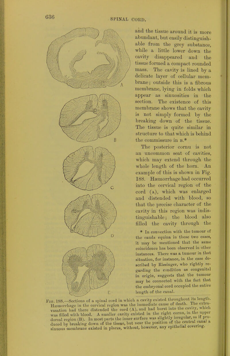 SPINAL CORD. aiid the tissue around it is more abundant, but easily distinguish- able from the grey substance, while a little lower down the cavity disappeared and the tissue formed a compact rounded mass. The cavity is lined by a delicate layer of cellular mem- brane; outside this is a fibrous membrane, lying in folds which appear as sinuosities in the section. The existence of this membrane shows that the cavity is not simply formed by the breaking down of the tissue. The tissue is quite similar in structure to that which is behind the commissure in b.* The posterior cornu is not an uncommon seat of cavities, which may extend through the whole length of the horn. An example of this is shown in Fig. 188. Haemorrhage had occurred into the cervical region of the cord (a), which was enlarged and distended with blood, so that the precise character of the cavity in this region was indis- tinguishable; the blood also filled the cavity through the * In connection with the tumour of the eauda equina in these two cases, it may be mentioned that the same coincidence has been observed in other instances. There was a tumour in that situation, for instance, in the case de- scribed by Riesinger, who rightly re- garding the condition as congenital in origin, suggests that the tumour may be connected with the fact that the embryonal cord occupied the entire length of the canal. G. 188.—Sections of a spinal cord iu which a cavity existed throughout its length. Ha3morrhagc in the cervical region was the immediate cause of death, lnc extra- vasation had there distended the cord (A), and had burst into the cavity, which was filled with blood. A smaller cavity existed in the right cornu in the upper dorsal region (B). In most parts the inner surface was slightly irregular, as it pro- duced by breaking down of the tissue, but near the position of the central canal a sinuous membrane existed in places, without, however, any epithelial covering. Fig