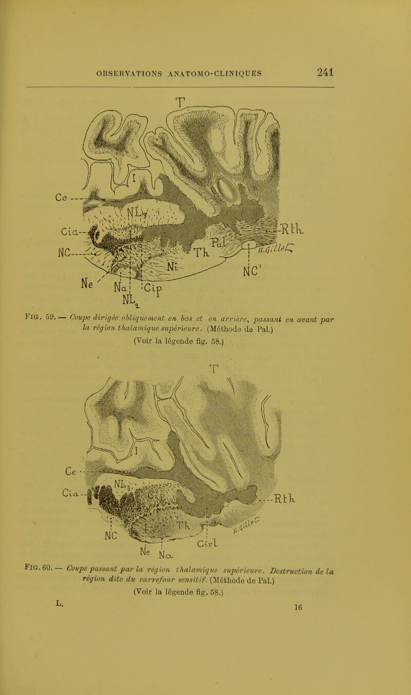 NC- Ce — NL, Fig. 59. — ^cwptf dirigée obliquement en bas et en arrière, passant en avant par la région thalamique supérieure. (Méthode de Pal.) (Voir la légende fig. 58.) Ne N CÎrl a- Fig. 60. — Coupe passant par la région thalamique supérieure. Destruction de la région dite du carrefour sensitif. (Méthode de Pal.) (Voir la légende fig. 58.) 16