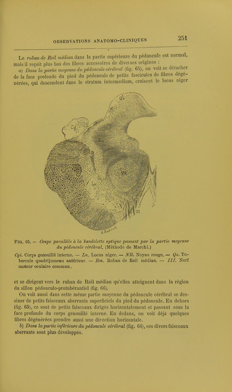 Le ruban de Eeil médian clans la partie supérieure du pédoncule est normal, mais il reçoit plus bas des libres accessoires de diveises origines : a) Dans la partie moyenne du pédoncule cérébral (fig. 65), on voit se délachcr de la face profonde du pied du pédoncule de petits fascicules de fibres dégé- nérées, qui descendent dans le stratum intermedium, croisent le locus mger Fig. 65. — Coupe parallèle a la bandelette optique passant par la partie moyenne du pédoncule cérébral. (Méthode de Marchi.) Cgi. Corps genouillé interne. — Ln. Locus niger. — NU. Noyau rouge. — Qa. Tu- bercule quadrijumeau antérieur. — Jim. Kuban de Eeil médian. — III. Nerf moteur oculaire commun. et se dirigent vers le ruban de Reil médian qu'elles atteignent dans la région du sillon pédonculo-protubérantiel (fig. 66). On voit aussi dans cette même partie moyenne du pédoncule cérébral se des- siner de petits faisceaux aberrants superficiels du pied du pédoncule. En dehors (fig. 65), ce sont de petits faisceaux dirigés horizontalement et passant sous la face profonde du corps genouillé interne. En dedans, on voit déjà quelques fibres dégénérées prendre aussi une direction horizontale. 6) Dans la partie inférieure du pédoncule cérébral (fig. 66), ces divers faisceaux aberrants sont plus développés.