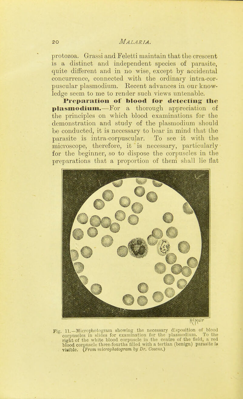 protozoa. Grassi and Feletii maintain that tlie crescent is a distinct and independent species of parasite, quite different and in no wise, except by accidental concurrence, connected with the ordinary intra-cor- puscular plasmodium. Recent advances in our know- ledge seem to me to render such views untenable. Preparation of blood for dctectiug tlic Plasmodium.—For a thorough appreciation of the principles on which blood examinations for the demonstration and study of the plasmodium should be conducted, it is necessary to bear in mind that the parasite is intra-corpuscular. To see it with the microscope, therefore, it is necessary, particularly for the beginner, so to dispose the corpuscles in the preparations that a pi^oportion of them sl)aU lie flat Fig. 11.—Micropholcigrain showing the necessary disposition of Wood corpuscles in slides for examination for the idasniodiuni. To the right of the wliite blood corpiisele in tlic centre of the field, a red blood corpuscle three-fourtlis filled with a tertian (benign) parasite is visible. {From microphotogram by Dr. Cosetis.)
