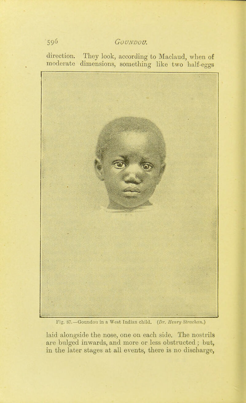 '59^ Goundou. direction. They look, according to Maclaud, wlien of moderate dimensions, something Hke two lialf-eggs Fig. 87.—Goundou in a West Indian child. (Dr. Henry Slraclian.) laid alongside the nose, one on each side. The nostrils are bulged inwards, and more or less obstructed ; but, in the later stages at all events, there is no discharge,