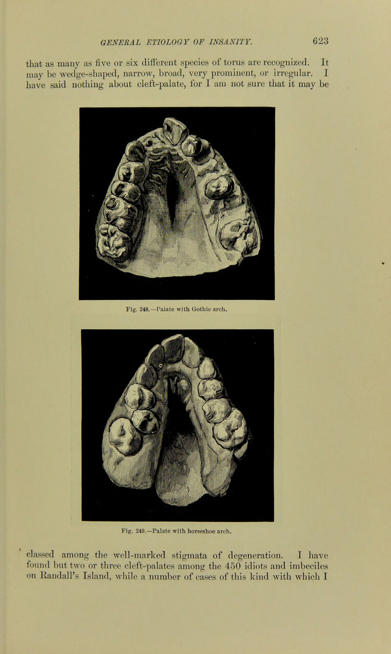 that as many as five or six different species of torus are recognized. It may be wedge-shaped, narrow, broad, very prominent, or irregular. I have said nothing about cleft-palate, for I am not sure that it may be Fig. 248.—Palate with Gothic arch. Fig. 249.—Palate with horseshoe arch. classed among the well-marked stigmata of degeneration. I have found but two or three cleft-palates among the 450 idiots and imbeciles on Randall's Island, while a number of cases of this kind with which I