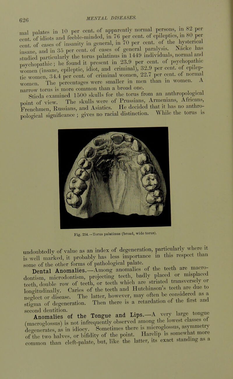 ma] in LO per cent, of apparently norma persons, ... S2 per Mlt Pf kiiots and feeble-minded, in 76 per cent, of epileptics, in 80 per eLt of cases of insanity in general, in 70 per cent of the hysterical insane and in 35 per cent, of cases of general paralysis. JNacke lias studied particularly the torus palatums in 1449 individuals, normal and psychopathic; he found it present in 23.9 per cent, of psychopathic women (insane, epileptic, idiot, and criminal), 32.9 per cent, of epilep- tic women, 34.4 per cent, of criminal women, 22.7 per cent, of norma] women. The percentages were smaller in men than in women. A narrow torus is more common than a broad one. Sticda examined 1500 skulls for the torus from an anthropological point of view. The skulls were of Prussians, Armenians, Africans, Frenchmen, Russians, and Asiatics. He decided that it has no anthro- pological significance ; gives no racial distinction. While the torus is Fig. 254.—Torus palatinus (broad, wide torus). undoubtedly of value as an index of degeneration, particularly where it is well marked, it probably has less importance in this respect than some of the other forms of pathological palate. Dental Anomalies.—Among anomalies of the teeth are macro- dontism, microdontism, projecting teeth, badly placed or nusp aced teeth, double row of teeth, or teeth which are striated transversely or longitudinally. Caries of the teeth and Hutchinson s teeth are due to neglect or disease. The latter, however, may often be considered as a stigma of degeneration. Then there is a retardation of the first and second dentition. . Anomalies of the Tongue and Lips.-A very large temgue (maoroglo3SUs) is not infrequently observed among the .owes, e ass es degenerates, as in idiocy. Sometimes there ■ mmrog ossus, as - of the two halves, or l.ifidity of the point. Harelip is somewhat mon _u than cleft-palate, but, like the latter, its exact standing aa a