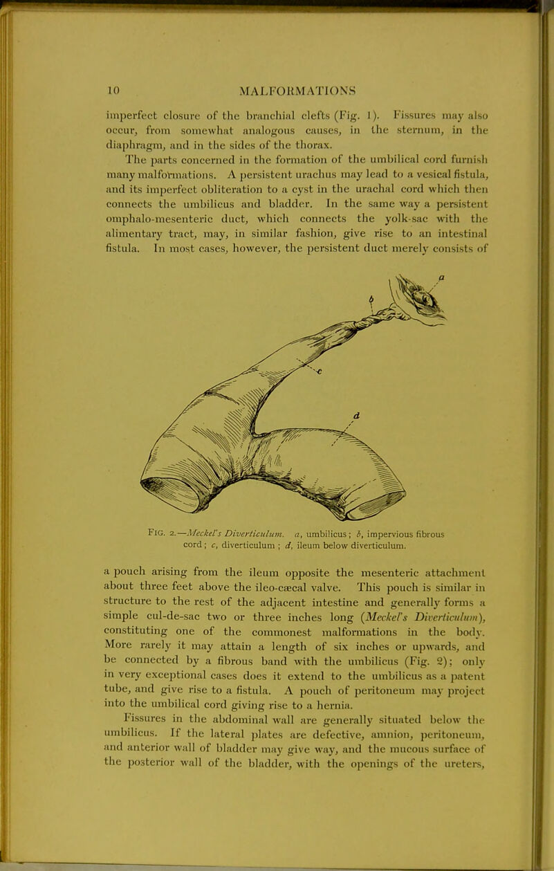 imperfect closure of tlie bninchinl clefts (Fig. 1). Fissures may also occur, from somewhat analogous causes, in the sternum, in the diaphragm, and in the sides of the thorax. The parts concerned in the formation of the umbilical cord furnish many malformations. A persistent urachus may lead to a vesical fistula, and its imperfect obliteration to a cyst in the urachal cord which then connects the umbilicus and bladder. In the same way a persistent omphalo-mesenteric duct, which connects the yolk-sac with the alimentar}' tract, may, in similar fashion, give rise to an intestinal fistula. In most cases, however, the persistent duct merely consists of Fig. 2.—Meckel's Diverticulum, a, umbilicus; 6, impervious fibrous cord ; c, diverticulum ; d, ileum below diverticulum. a pouch arising from the ileum opposite the mesenteric attachment about three feet above the ileo-csecal valve. This pouch is similar in structure to the rest of the adjacent intestine and generally forms a simple cul-de-sac two or three inches long (Meckel's Diverticulum), constituting one of the commonest malformations in the body. More rarely it may attain a length of six inches or upwards, and be connected by a fibrous band with the umbilicus (Fig. 2); only in very exceptional cases does it extend to the umbilicus as a jjatent tube, and give rise to a fistula. A pouch of peritoneum may project into the umbilical cord giving rise to a hernia. Fissures in the abdominal wall are generally situated below the umbilicus. If the lateral plates are defective, amnion, peritoneum, and anterior wall of bladder may give way, and the mucous surface of the posterior wall of the bladder, with the openings of the ureters.