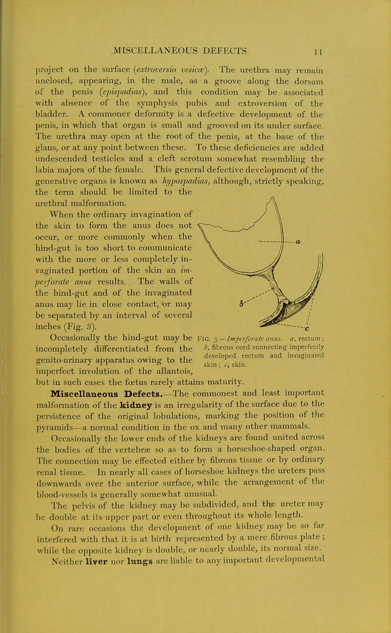 MISCELLANEOUS DEFECTS project on the surface (extroversio vesicae). The urethra may remain unclosed, appearing, in the male, as a groove along the dorsum of the penis {epispadias), and this condition may be associated with absence of the symphysis pubis and extroversion of the bladder. A commoner deformity is a defective development of the penis, in which that organ is small and grooved on its under surface. The ui'ethra may open at the root of the penis, at the base of the glans, or at any point between these. To these deficiencies are added undescended testicles and a cleft scrotum somewhat resembling the labia majora of the female. This general defective development of the generative organs is known as hypospadias, although, strictly speaking, the term should be limited to the urethral malformation. When the ordinary invagination of the skin to form the anus does not occur, or more commonly when the hind-ffut is too short to communicate with the more or less completely in- vaginated portion of the skin an im- perforate anus results. The walls of the hind-gut and of the invaginated anus may lie in close contact, or may be separated by an interval of several inches (Fig. 3). Occasionally the hind-gut maybe Y^g. ■i.—Imperforate anus. <?, rectum ; incompletely differentiated from the fibrous cord connecting imperfectly ... . • i ii developed rectum and invaginated genito-urmarv apparatus owing to the ,. ,. ° .7 z r & 5l^,n ; c, skin. imperfect involution of the allantois, but in such cases the foetus rarely attains maturity. Miscellaneous Defects.—The commonest and least important malformation of the kidney is an irregularity of the surface due to the persistence of the original lobulations, marking the position of the pyramids—a normal condition in the ox and many other mammals. Occasionally the lower ends of the kidneys are found united across the bodies of the vertebrae so as to form a horseshoe-shaped organ. The connection may be effected either by fibrous tissue or by ordinary renal tissue. In nearly all cases of horseshoe kidneys the ureters pass downwards over the anterior surface, while the arrangement of the blood-vessels is generally somewhat unusual. The pelvis of the kidney may be subdivided, and the ureter may be double at its upper part or even throughout its whole length. On rare occasions the development of one kidney may be so far interfered with that it is at birth represented by a mere fibrous plate ; while the opposite kidney is double, or nearly double, its normal size. Neither liver nor lungs are liable to any important developmental