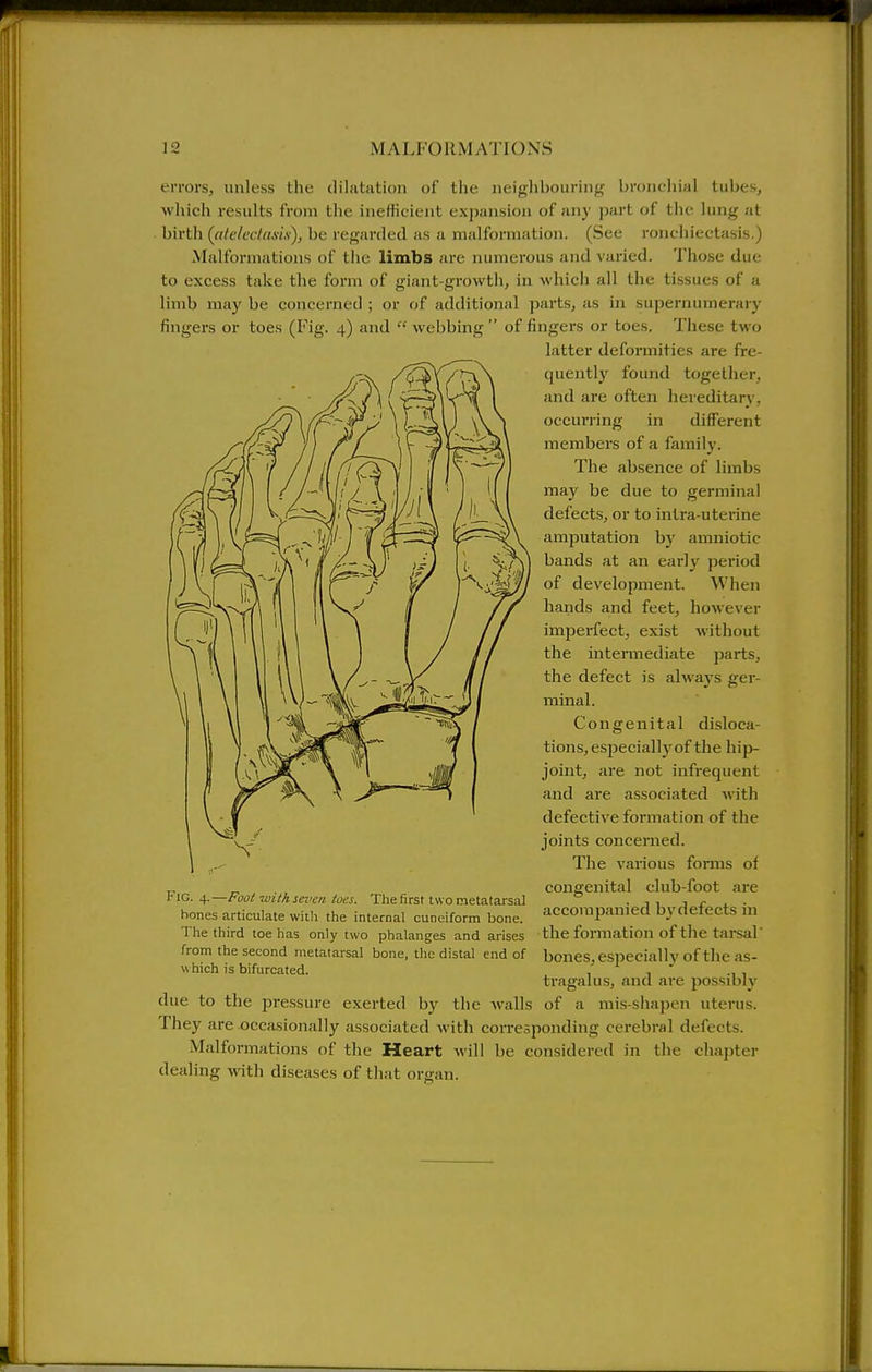 errors, luiless the dilatation of the neighbouring broncliial tubes, which results from the inefficient expansion of any part of the lung at birth (atc/ccldxix), be regarded as a malformation. (See ronchiectasis.) Malformations of the limbs are numerous and varied. Those due to excess take the form of giant-growth, in which all the tissues of a limb may be concerned ; or of additional parts, as in supernumerary fingei-s or toes (Fig. 4) and  webbing  of fingers or toes. These two latter deformities are fre- quentlj^ found together, and are often hereditary, occurring in different members of a family. The absence of limbs may be due to germinal defects, or to intra-uterine amputation by amniotic bands at an early period of development. When hands and feet, however imperfect, exist without the intermediate parts, the defect is always ger- minal. Congenital disloca- tions, especially of the hip- joint, are not infrequent and are associated with defective formation of the joints concerned. The various forms of congenital club-foot are accompanied bydefects in the formation of the tarsal' bones, especially of the as- tragalus, and are possibly of a mis-shapen uterus. Fig. ^.—Foot with seven toes. The first two metatarsal hones articulate with the internal cuneiform bone. The third toe has only two phalanges and arises from the second metatarsal bone, the distal end of w hich is bifurcated. due to the pressure exerted by the walls They are occasionally associated Avith corresponding cerebral defects. Malformations of the Heart will be considered in the chapter dealing with diseases of that organ.