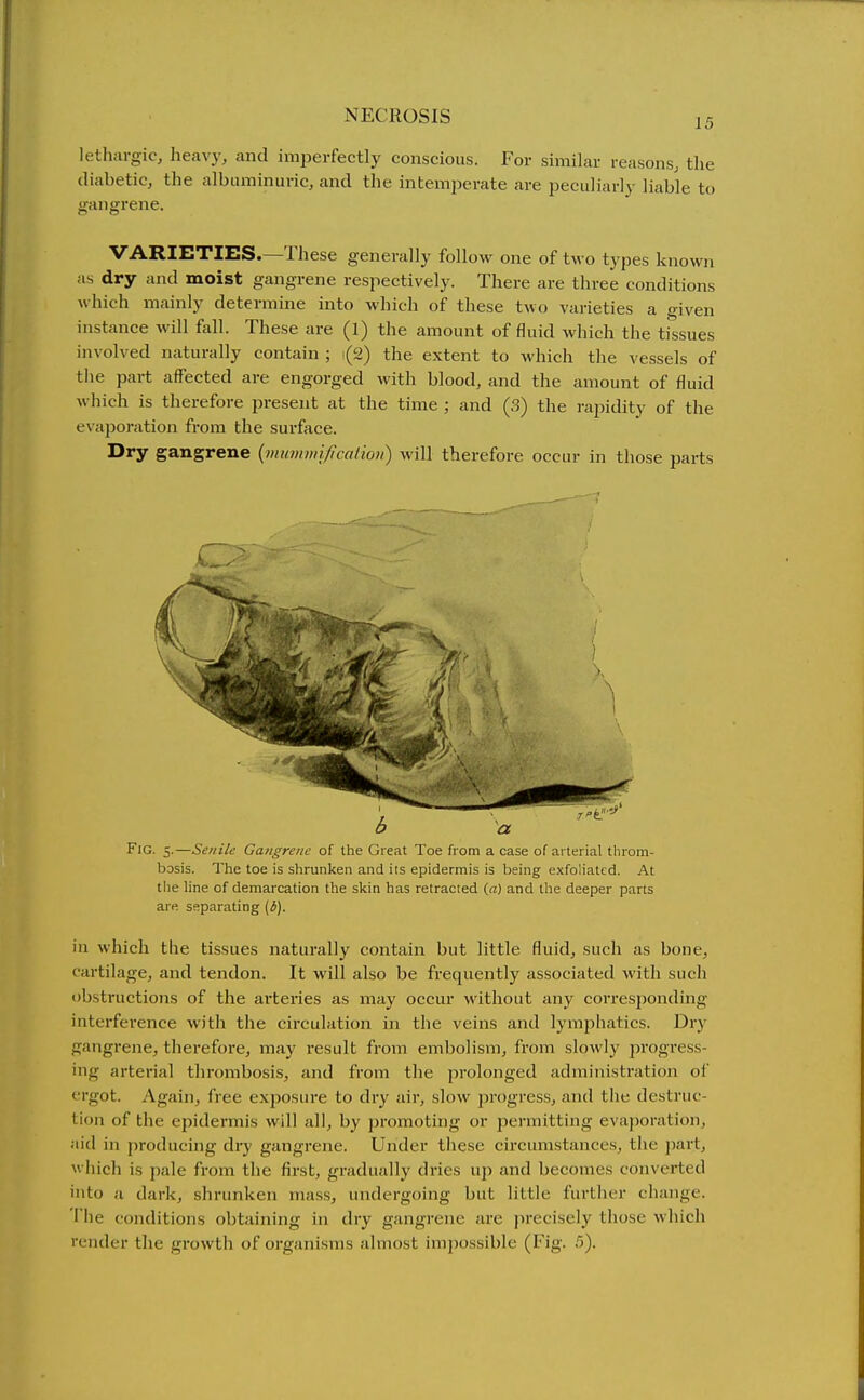 15 lethargic, heavy, and imperfectly conscious. For similar reasons, tlie diabetic, the albuminuric, and the intemperate are peculiarly liable to gangrene. VARIETIES.—These generally follow one of two types known as dry and moist gangrene respectively. There are three conditions which mainly determine into which of these two varieties a given instance will fall. These are (1) the amount of fluid which the tissues involved naturally contain ; 1(2) the extent to which the vessels of the part affected are engorged with blood, and the amount of fluid which is therefore present at the time ; and (3) the ra2iidity of the evaporation from the surface. Dry gangrene {viummi/iccdion) will therefore occur in those parts Fig. 5.—Senile Gangrene of the Great Toe from a case of arterial throm- bosis. The toe is shrunken and its epidermis is being exfoliated. At the line of demarcation the skin has retracted (a) and the deeper parts are separating {b). in which the tissues naturally contain but little fluid, such as bone, cartilage, and tendon. It will also be frequently associated with such obstructions of the arteries as may occur without any corresponding- interference with the circulation in the veins and lymphatics. Dry gangrene, therefore, may result from embolism, from slowly progress- ing arterial thrombosis, and from the prolonged administration ol' ergot. Again, free exposure to dry air, slow progress, and the destruc- tion of the epidermis will all, by i)romoting or permitting evaporation, aid in producing dry gangrene. Under these circumstances, the \nw\., which is pale from the first, gradually dries up and becomes converted into a dark, shrunken mass, undergoing but little further change. The conditions obtaining in dry gangrene are precisely those which render the growth of organisms almost imjjossible (Fig. 5).