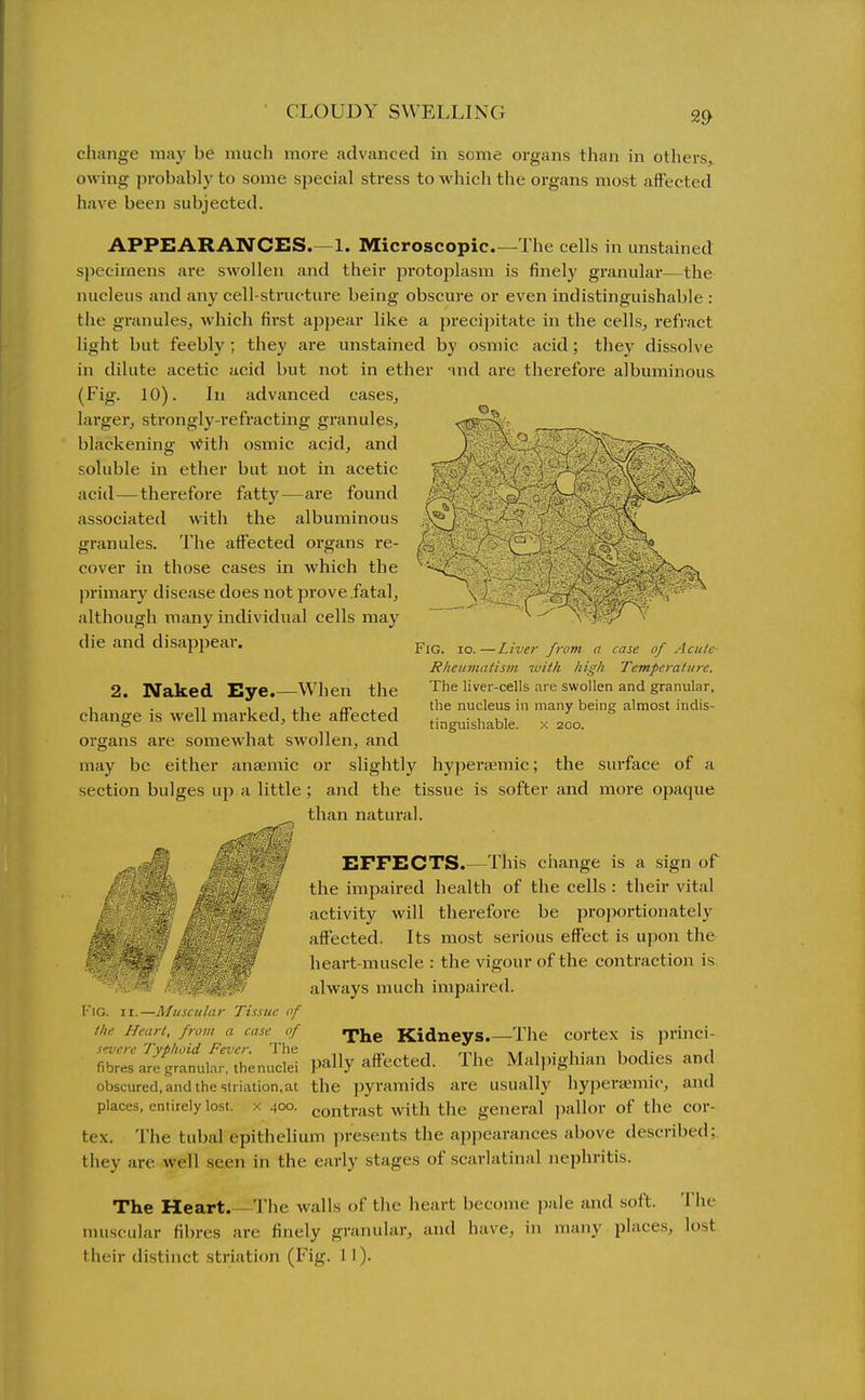 CLOUDY SWELLING change may be nuicli more advanced in some organs than in others, owing probably to some special stress to which the organs most affected have been subjected. APPEARANCES.—1. Microscopic—The cells in unstained specimens are swollen and their protoplasm is finely granular—the nucleus and any cell-structure being obscure or even indistinguishable : the granules, which first appear like a precipitate in the cells, refract light but feebly; they are unstained by osmic acid; they dissolve in dilute acetic acid but not in ether nnd are therefore albuminous (Fig. 10). In advanced cases, larger, strongly-refracting granules, blackening \Cith osmic acid, and soluble in ether but not in acetic acid—therefore fatty—are found associated with the albuminous granules. The affected organs re- cover in those cases in which the primary disease does not prove.fatal, although many individual cells may die and disappeai'. Fig. io.—Liver from a case of Acute- Rheumatism with high Temperature. The liver-cells are swollen and granular, the nucleus in many being almost indis- tinguishable. X 200. 2. Naked Eye.—When the change is well marked, the affected organs are somewhat swollen, and may be either anaemic or slightly hypertiemic; the surface of a and the tissue is softer and more opaque than natural. section bulges uj) a little EFFECTS.—This change is a sign of the impaired health of the cells : their vital activity will therefore be projwrtionately affected. Its most serious effect is upon the f heart-muscle : the vigour of the contraction is always much impaired. Fig. II.—Muscular Tissue nf the Heart, from a case of qij^g Kidneys.—The cortex is princi- s'Tjere Typhoid Fever. The „. , _,, t,, i . i . i i- i fibres are granular, thenuclei pally affected. The Maljxgh.an bodies and obscured, and the striation,at the pyramids are usually hyperajmic, antl places, entirely lost, x 400. contrast with the general jjallor of the cor- tex. The tubal epithelium presents the appearances above described; they are well seen in the early stages of scarlatinal nephritis. The Heart.—The walls of the heart become pale and soft. Tiic nniscular fibres are finely granular, and have, in many places, lost tlieir distinct striation (Fig. 1 !)•