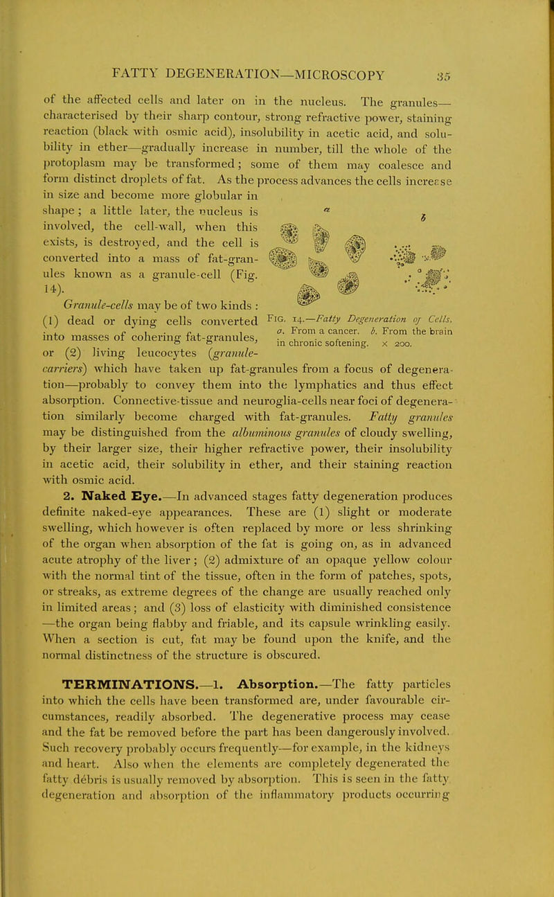FATTY DEGENERATION—MICROSCOPY of the affected cells and later on in the nucleus. The granules- characterised by their sharp contour, strong refractive power, staining reaction (black with osmic acid), insolubility in acetic acid, and solu- bility in ether—gradually increase in number, till the whole of the protoplasm may be transformed; some of them may coalesce and form distinct droplets of fat. As the process advances the cells increase in size and become more globular in shape ; a little later, the nucleus is * ^ involved, the cell-wall, Avhen this exists, is destroyed, and the cell is converted into a mass of ftit-gran- l.^p) •'iji? '^-^^^ ules known as a granule-cell (Fig. ;  '^'■^ 14). Granule-cells may be of two kinds : (1) dead or dying cells converted Degeneration oj Cells. ■ . c \ • jy L 1 From a cancer. I/. From the brain mto masses oi cohering rat-ffi'anules, ... , . o f ' m chronic softenmg. x 200. or (2) living leucocytes (^granule- carriers) which have taken up fat-granules from a focus of degenera- tion—probably to convey them into the lymphatics and thus effect absorption. Connective-tissue and neui'oglia-cells near foci of degenera- tion similarly become charged with fat-granules. Fatty granules may be distinguished from the albuminoiis granules of cloudy swelling, by their larger size, their higher refractive power, their insolubility in acetic acid, their solubility in ether, and their staining reaction with osmic acid. 2. Naked Eye.—In advanced stages fatty degeneration produces definite naked-eye appearances. These are (1) slight or moderate swelling, which however is often replaced by more or less shrinking of the organ when absorption of the fat is going on, as in advanced acute ati'ophy of the liver; (2) admixture of an ojjaque yellow colour witli the normal tint of the tissue, often in the fox*m of patches, spots, or streaks, as extreme degrees of the change are usually reached only in limited areas; and (3) loss of elasticity with diminished consistence —the organ being flabby and friable, and its capsule wrinkling easily. When a section is cut, fat may be found upon the knife, and the normal distinctness of the structure is obscured. TERMINATIONS.—1. Absorption.—The fatty particles into which the cells have been transformed are, under favourable cir- cumstances, readily absorbed. The degenerative process may cease and the fat be removed before the part has been dangerously involved. Such recovery probably occurs frequently—for example, in the kidneys and heart. Also when the elements are comjiletely degenerated the fatty debris is usually removed by absorption. This is seen in the fatty <legeneration and absorption of the inflammatory products occurring