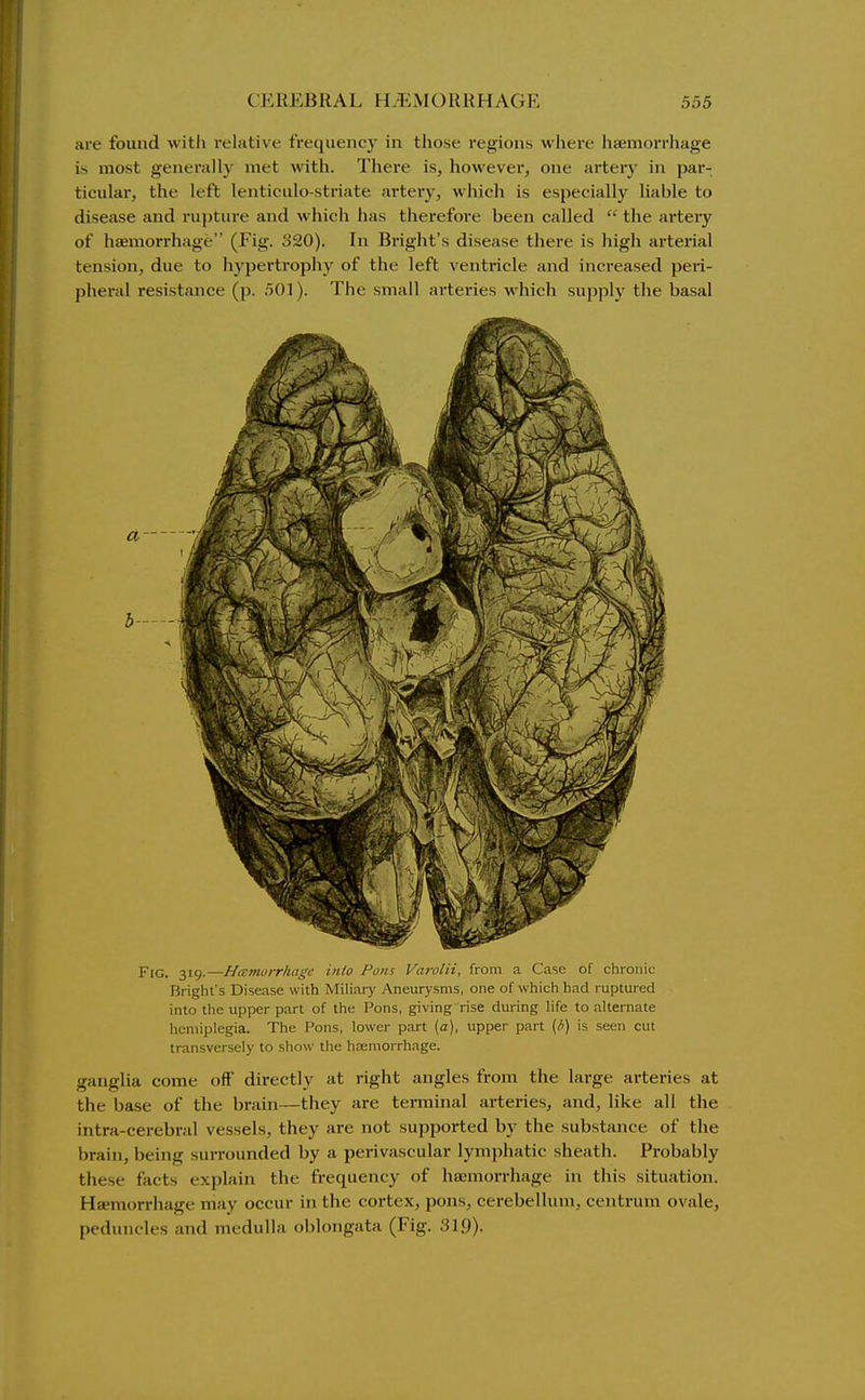 are found with relative frequency in those regions where liaemorrhage is most generally met Avith. There is, however, one artery in par- ticular, the left lenticulo-striate artery, which is especially liable to disease and rupture and which has therefore been called the arteiy of haemorrhage (Fig. 320). In Bright's disease there is high artei'ial tension, due to hypertrophy of the left ventricle and inci-eased peri- pheral resistance (p. 501). The small arteries which supply the basal Fig. 319.—Hmmorrhage into Pons Varolii, from a Case of chronic Bright's Disease with Miliary Aneurysms, one of which had ruptured into the upper part of the Pons, giving rise during Hfe to alternate hemiplegia. The Pons, lower part (a), upper part is seen cut transversely to show the haemorrhage. ganglia come off directly at right angles from the large arteries at the base of the brain—they are terminal arteries, and, like all the intra-cerebral vessels, they are not supported by the substance of the brain, being surrounded by a perivascular lymphatic sheath. Probably these facts explain the frequency of hajmorrhage in this situation. Haemorrhage may occur in the cortex, pons, cerebellum, centrum ovale, peduncles and medulla oblongata (Fig. 319).