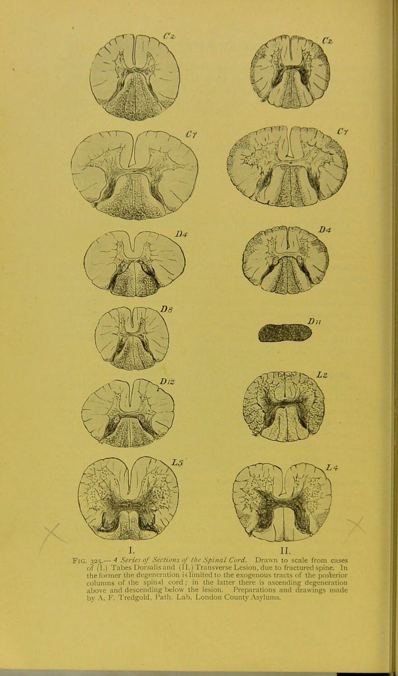 Fig. 325.— 4 Scries of Sections of the Spinal Cord. Drawn to scale from cases of (I.) Tabes Uorsalisand (11.) Transverse Lesion, due to fractured spine. In the former the degeneration is limited to the e.xogenous tracts of the posterior columns of ihe spin-il cord ; in the latter there is ascending degeneration above and descending below the lesion. Preparations and drawings made by .\. 1'. Trcdgold, Path. Lab. London Count}'.Asylums.