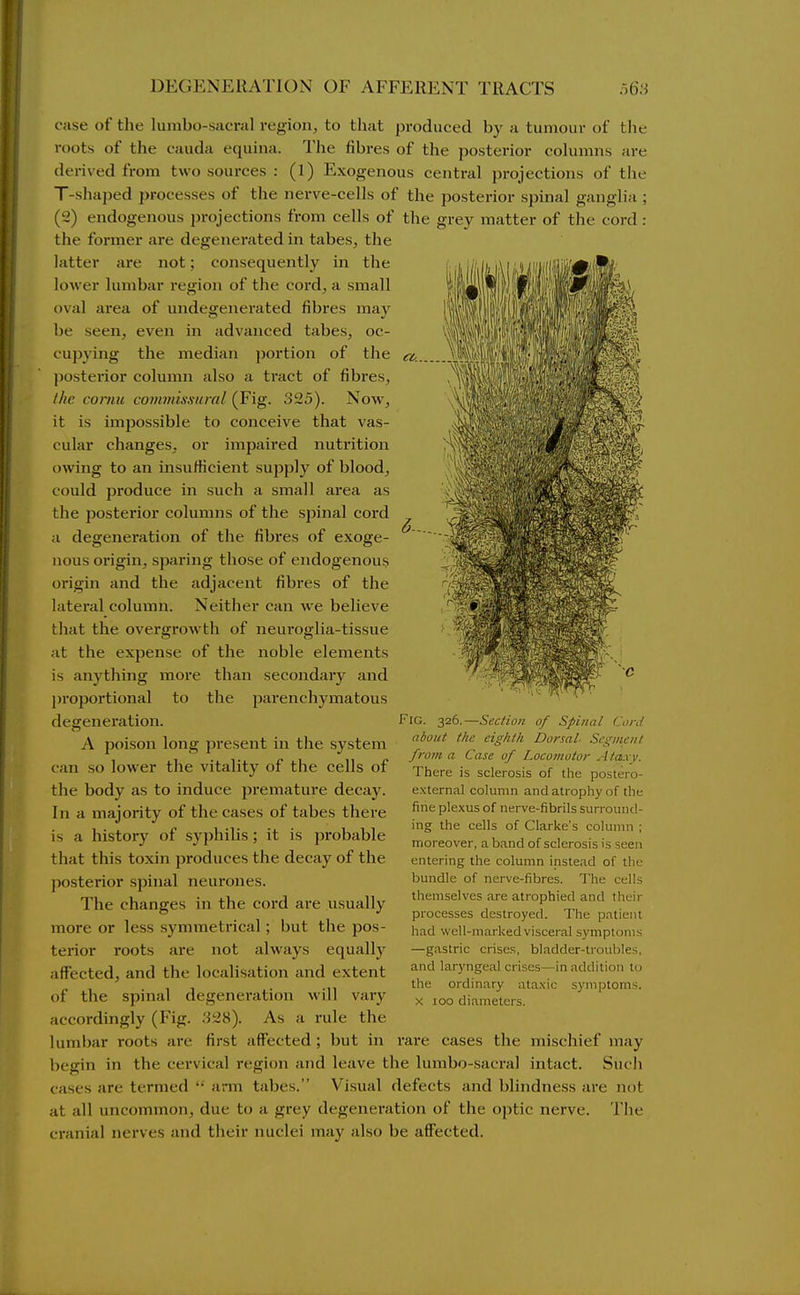 case of the lumbo-sacral region, to that produced by a tumour of the roots of the cauda equina. The fibres of the posterior columns are derived from two sources : (l) Exogenous central projections of tlie T-shaped processes of the nerve-cells of the posterior spinal ganglia ; (2) endogenous projections from cells of the grey matter of the cord : the former are degenerated in tabes, the latter are not; consequently in the lower lumbar region of the cord, a small oval area of undegenerated fibres may be seen, even in advanced tabes, oc- cupying the median portion of tlie posterior column also a tract of fibi'es, the cornu commissural (Fig. 325). Now, it is impossible to conceive that vas- cular changes, or impaired nutrition owing to an insufficient supply of blood, could produce in such a small area as the postei'ior columns of the spinal cord a degeneration of the fibres of exoge- nous origin, sparing those of endogenou$ origin and the adjacent fibres of the lateral column. Neither can we believe that the overgrowth of neuroglia-tissue at the expense of the noble elements is anything more than secondary and jiroportional to the parenchymatous degeneration. A poison long present in the system can so lower the vitality of the cells of the body as to induce premature decay. In a majority of the cases of tabes there is a history of syphilis; it is probable that this toxin produces the decay of the jiosterior spinal neurones. The changes in the cord are usually more or less symmetrical; but the pos- terior roots are not always equally affected, and the localisation and extent of the spinal degeneration will vary accordingly (Fig. 328). As a rule the lumbar roots are first affected; but in Fig. 326.—Section of Spinal Cord about the eighth Dorsal Segment from a Case of Locomotor Ataxy. There is sclerosis of tlie postero- external column and atrophy of the fine plexus of nerve-fibrils surround- ing the cells of Clarke's column ; moreover, a band of sclerosis is seen entering the column instead of the bundle of nerve-fibres. The cells themselves are atrophied and their processes destroyed. The patient had well-marked visceral symptoms —g.astric crises, bladder-troubles, and laryngeal crises—in addition to the ordinary ataxic symptoms. X 100 diameters. rare cases the mischief may begin in the cervical region and leave the lumbo-sacral intact. Such cases are termed '•' ann tabes. Visual defects and blindness are not at all uncommon, due to a grey degeneration of the optic nerve. The cranial nerves and their nuclei may also be affected.