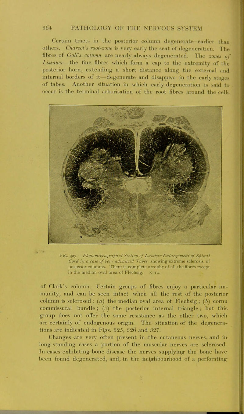 Certain tracts in the posterior eolunni dej^enerat*' earlier tlian others. C/ifircol'x rool-::oiic is very early tiie seat of degeneration. 'I'lie fibres of (io/l'x coliniiii are nearly always degenerated. The .;o//e.v of IJxxdiH-r—the fine fibres which form a cap to the extremity of the jjosterior horn, extending a short distance along the external and internal borders of it—degenerate and disappear in the early stages of tabes. Another situation in which early degeneration is said to occur is the terminal arborisation of the root fii)res around the cells Fig. 327.—Photomicrograph Section of Lumbar Enlargement of Spinal Cord in a case of verv advanced Tabes, showing extreme sclerosis of posterior columns. There is complete atrophy of all the fibres e.vcept in the median oval area of Flechsig. >; 10. of Clark's colimm. Certain grou])s of fibres enjoy a particular im- munity, and can be seen intact when all the rest of the posterior column is sclerosed : («) the median oval area of Flechsig; (6) cornu commissural bundle; (c) the posterior internal triangle; but this, group does not offer the same resistance as the other two, which are certainly of endogenous origin. The situation of the degenera- tions are indicated in Figs. 325, .'526' and .'?27. Changes are very often present in the cutaneous nerves, and in long-standing cases a ]iortion of the muscular nerves are sclerosed. In cases exhibiting bone disease the nerves supplying the bone have been found degenerated, and, in the iieighboiu'hood of a perforating^