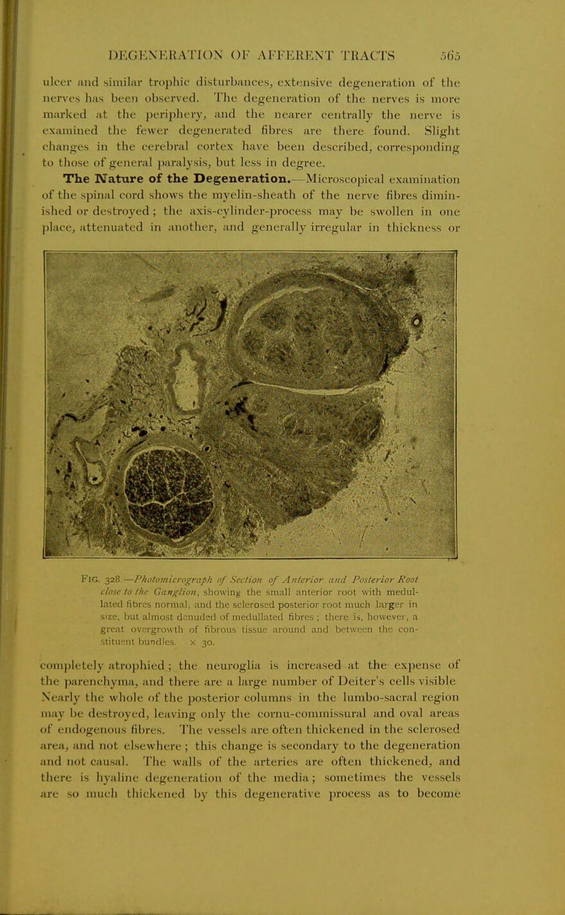 ulcer and similar trophic disturbances, extensive degeneration of the nerves has been observed. Tlie degeneration of the nerves is more marked at the periphery, and the nearer centrally the nerve is examined the fewer degenerated fibi'es are there found. Slight changes in the cerebral cortex have been desci-ibed, corresjjonding to those of general paralysis, but less in degree. Tlie Nature of the Degeneration.—Microscopical examination of the sjiinal cord shows the myelin-sheath of the nerve fibres dimin- ished or destroyed ; the axis-cylinder-process may be swollen in one place, attenuated in another, and generally irregular in thickness or I ■ : .. -n Fig. 328.—Photomicrograph of Section of Anterior and Posterior Root close to the Ganglion, showing the small anterior root with medul- lated fibres normal, and the sclerosed posterior root much larger in size, but almost denuded of niedullated fibres ; there is, however, a great overgrowth of fibrous tissue around and between the con- stituent bundles, x 30. comj)letely atrophied; the neuroglia is increased at the expense of the parenchyma, and there are a large number of Deiter's cells visible Nearly the whole of the posterior columns in the lumbo-sacral region may be destroyed, leaving only the cornu-commissural and oval areas of endogenous fibres. The vessels are often thickened in the sclerosed area, and not elsewhere ; this change is secondary to the degeneration and not causal. The walls of the arteries are often thickened, and there is hyaline degeneration of the media; sometimes the vessels are so much tliickened by this degenerative process as to become