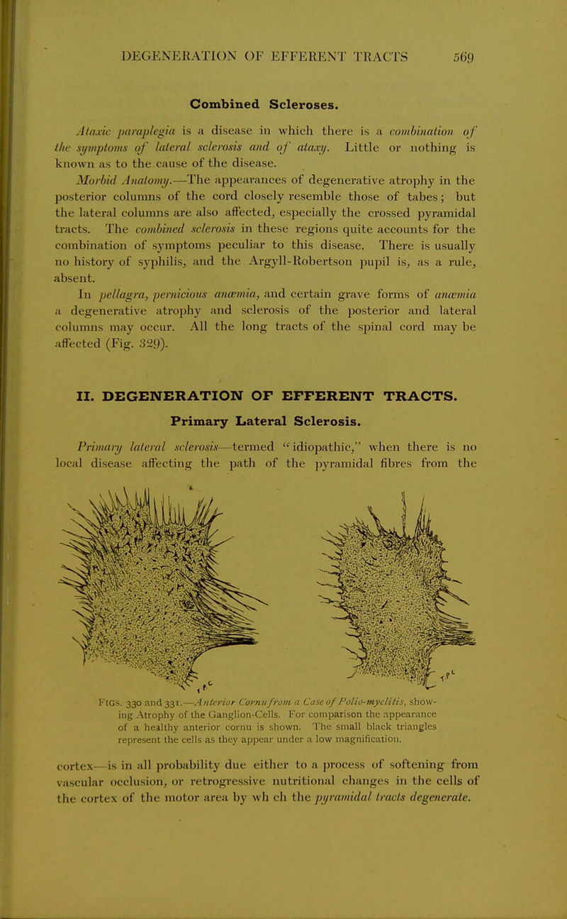 Combined Scleroses. .lluxic paraplegia is a disease in whicli there is a combination of the sijmploms of lateral sclerosis and of ataxy. Little or nothing is known as to the cause of the disease. Morbid Anaiomi),—The appearances of degenerative atrophy in the posterior coknnns of the cord closely resemble those of tabes; but the lateral columns are also affected, especially the crossed pyramidal tracts. The combined sclerosis in these regions quite accounts for the combination of symptoms peculiar to this disease. There is usually no history of syphilis, and the Argj'^ll-Robertson pupil is, as a rule, absent. In pellagra, pernicious ancemia, and certain grave forms of amemia a degenerative atrophy and sclerosis of the posterior and lateral columns may occur. All the long tracts of the sjiinal cord may be affected (Fig. 329). II. DEGENERATION OF EFFERENT TRACTS. Primary Lateral Sclerosis. Primai-y lateral sclerosis—termed idiopathic, when there is no local disease affecting the jjath of the pyramidal fibres from the Figs. 330 and 331.—Anterior Coniufroiii a Case of Polio-myelitis, show- ing Atrophy of the Ganglion-Cells. For comparison the appearance of a healthy anterior cornu is shown. The small black triangles represent the cells as they appear under a low magnification. cortex—is in all probability due either to a j)rocess of softening from vascular occlusion, or retrogressive nutritional changes in the cells of the cortex of the motor area by wh cli the pijramidal tracts degenerate.