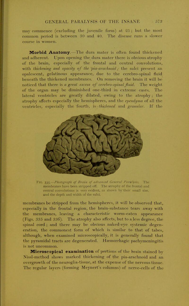 may commence (excluding the juvenile form) at 25 ; but the most common period is between .'JO and 40. 'J'he disease runs a slower course in women. Morbid Anatomy.—The dura mater is often found thickened and adherent. Upon opening the dura mater there is obvious atroj)hy of the brain, especially of the frontal and centivil convolutions, with thickening and opacitij of the 'pia-arachnoid; the sulci 2ii'esent an opalescent, gelatinous ajipearance, due to the cerebro-spinal fluid beneath the thickened membranes. On removing the brain it will be noticed that there is a great excesx of cerebro-.ipinal fluid. The weight of the organ may be diminished one-third in extreme cases. The lateral ventricles are greatly dilated, owing to the atrophy; the atrophy affects especially the hemispheres, and the ependyma of all the ventricles, especially the fourth, is • thickened and granular. If the Fig. 335.—Photograph of Brain of advanced General Para/ysis. The membranes have been stripped off. The atrophy of the frontal and central convolutions is very evident, as shown by'their small size, and the depth and width of the sulci. membranes be sti-ipped from the hemispheres, it will be observed that, especially in the frontal region, the brain-substance tears away with the membranes, leaving a characteristic worm-eaten appearance (Figs. 335 and 336). The atrophy also affects, but to a less degree, the spinal cord ; and there may be obvious naked-eye systemic degen- eration, the commonest form of which is similar to that of tabes, although, when examined microscopically, it is generally found that the pyramidal tracts are degenerated. Haemorrhagic pachymeningitis is not uncommon. Microscopical eicamination of portions of the brain stained by Nissl-method shows marked thickening of the pia-arachnoid and an overgrowth of the neuroglia-tissue, at the expense of the nervous tissue. The regular layers (forming Meynert's columns) of nerve-cells of the