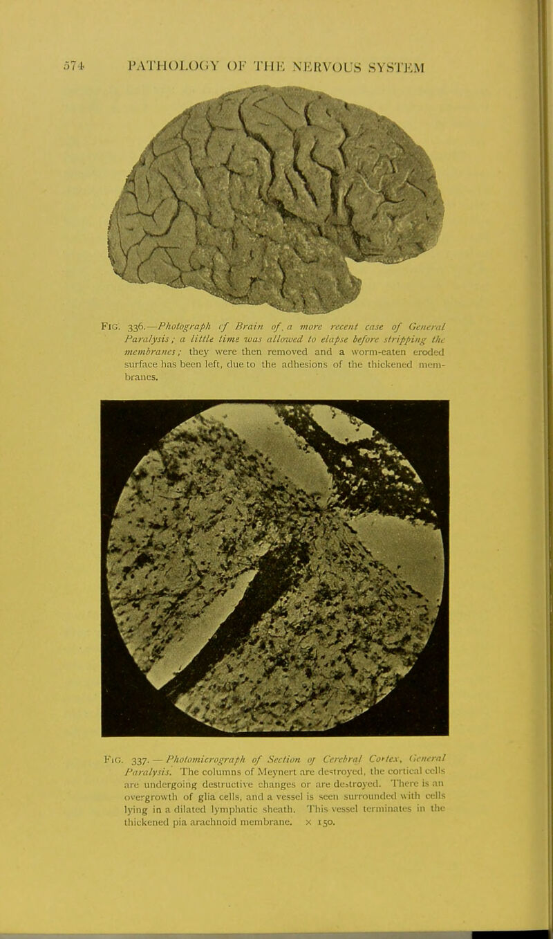 Fig. 336.—Photograph cf Brain of. a jixore recent case of General Paralysis; a little time was allowed to elapse before stripping (he memhrancs; they were then removed and a worm-eaten eroded surface has been left, due to tlie adhesions of the thickened mem- branes. FiG. 337. — Pholoviicrograph of Section oj Cerebral Cortex, Ceneral Paralysis^ The columns of Meynert are destroyed, the cortical cells are undergoing destructive changes or are dcalroj'ed. There is an overgrowth of glia cells, and a vessel is seen surrounded with cells lying in a dilated lynijjhatic sheath. This vessel terminates in the thickened pia arachnoid membrane, x 150.