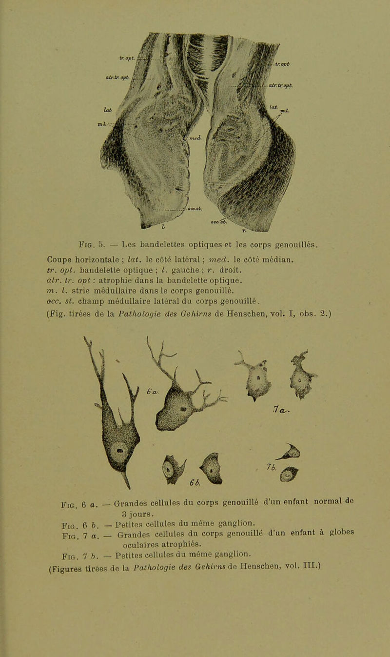 1^. ^ T. • - . - FiG. ô. — Les bandelettes optiques et les coi-ps genouillés. Coupe horizontale ; lat. le côté latéral ; med. le côté médian. tr. opt. bandelette optique ; l. gauche ; r. droit. atr. Ir. opt : atrophie dans la bandelette optique. m. l. strie médullaire dans le corps genouillé. occ, st. champ médullaire latéral du corps genouillé, (Fig. tirées de la Pathologie des Gehirns de Henschen, vol. I, obs. 2.) FtG. 6 o. Fig. 6 b. FiG. 7 a. Fig. 7 b. — Grandes cellules du corps genouillé d'un enfant normal de 3 jours. — Petites cellules du même ganglion. — Grandes cellules du corps genouillé d'un enfant à globes oculaires atrophiés. — Petites cellules du même ganglion. (Figures tirées de la Pathologie des Gehirns de Henschen, vol. ITI.)