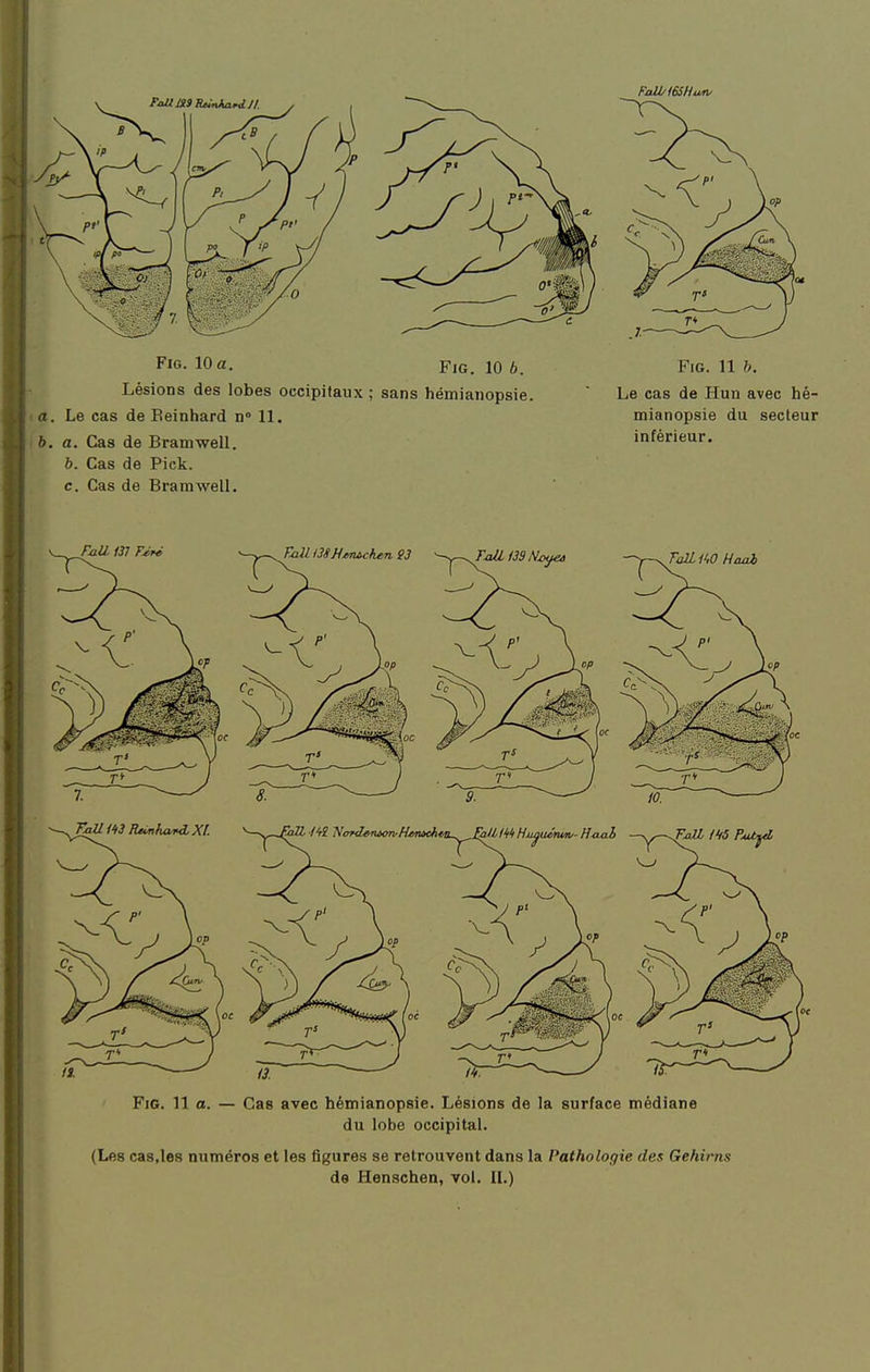 Lésions des lobes occipitaux ; sans hémianopsie. a. Le cas de Eeinhard n» 11. b. a. Cas de Branrwell. b. Cas de Pick. c. Cas de Brarawell. Le cas de Hun avec hé- mianopsie du secteur inférieur. FiG. 11 o. — Cas avec hémianopsie. Lésions de la surface médiane du lobe occipital. (Les cas.les numéros et les figures se retrouvent dans la Pathologie des Gehirns de Henschen, vol. IL)
