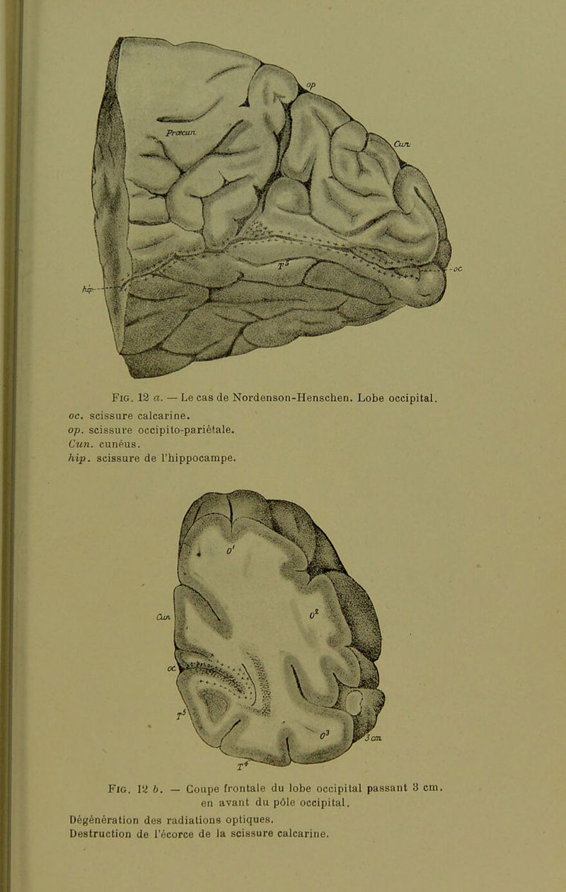 oc. scissure calcarine. op. scissui-e occipilo-pariétale. Cun. cunéus. /lip. scissure de l'hippocampe. i FiG. VI b. — Coupe frontale du lobe occipital passant 3 cm. en avant du pôle occipital. Dégénération des radiations optiques. Destruction de l'écorce de la scissure calcarine.