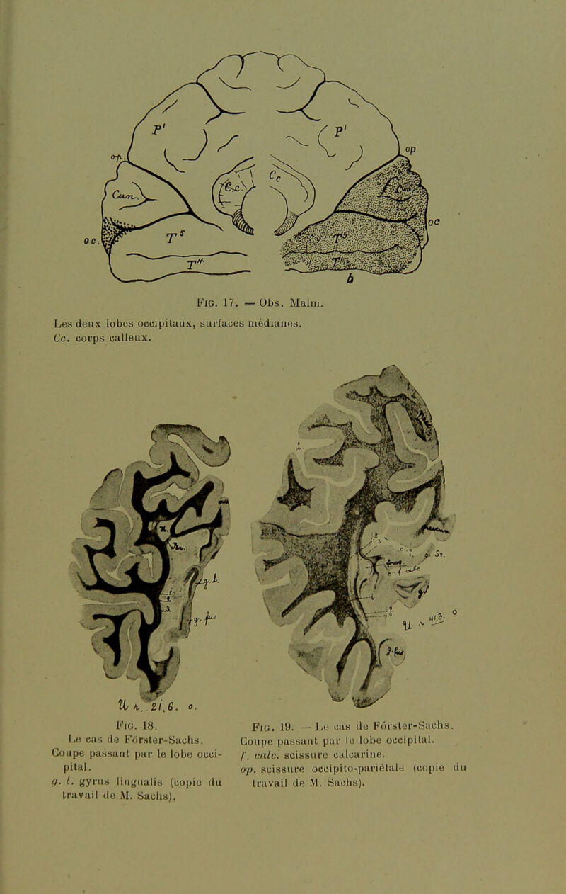 Les deux lobes ocuiplluux, surfaces niédiuiies. Ce. corps calleux. FiG. 18. FiG. 19. — Lo eus do Fôrsler-Sachs. Lb cas de For.ster-Saclis. Coupe passant par Ui lobe occipital. Coupe passant par le lobe occi- f_ cale, scissuro calcariiie. pital. op. scissure occipilo-pariétale (copie du g. l. gyrus liiitjualis (copie du travail de M. Sachs), travail de M. Sacl»s),