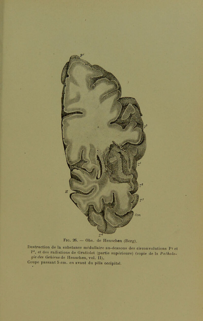 FiG. 26. — Obs. de Henschen (Berg). Destruction de la substance médullaire au-dessous des circonvolutions Pi et P-, et de.^ radiations de Gratiolet (partie supérieure) (copie de la Patholo- gie des Gehirnsde Henschen, vol. II). Coupe passant 5 cm. en avant du pôle occipital.