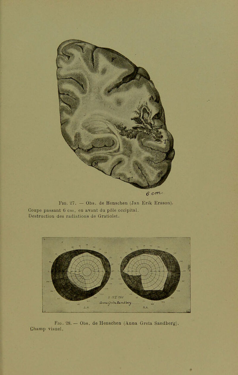 6 c/r^ FiG. y?. — Obs. de Henschen (Jan Erik Ersson). Coupe passant 6 cm, en avant du pôle occipital. Destruction des radiations de Gratioiet.
