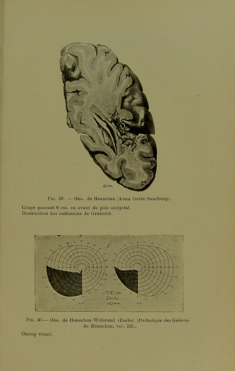 Coupe passant 6 cm. en avant du pôle occipital. Destruction des radiations de Gratiolet.