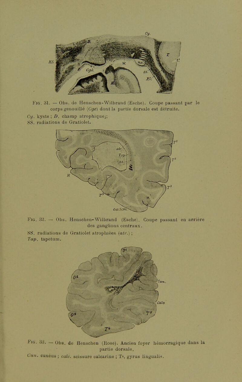 FiG. 31. — Obs. (le Henschen-Wilbraiid (Esche). Coupe passant par le corps genouillé [Cge) dont la partie dorsale est détruite. Cy. kyste; D. champ atrophiquei; isS. radiations de Gratiolet. FiG. 32. — Obs. Hensctien-Wiibrand (Esche). Coupe passant en arrière des ganglions centraux. .Si>. radiations de Gratiolet atrophiées {atv.) ; Tap. tapetum. Cala Fiu. ya. — Obs. de Henschen (Rose). Ancien foyer hémorragique dans la partie dorsale. Cuil. cunéus ; cale, scissure calcarine ; T^, gyrus lingualis.