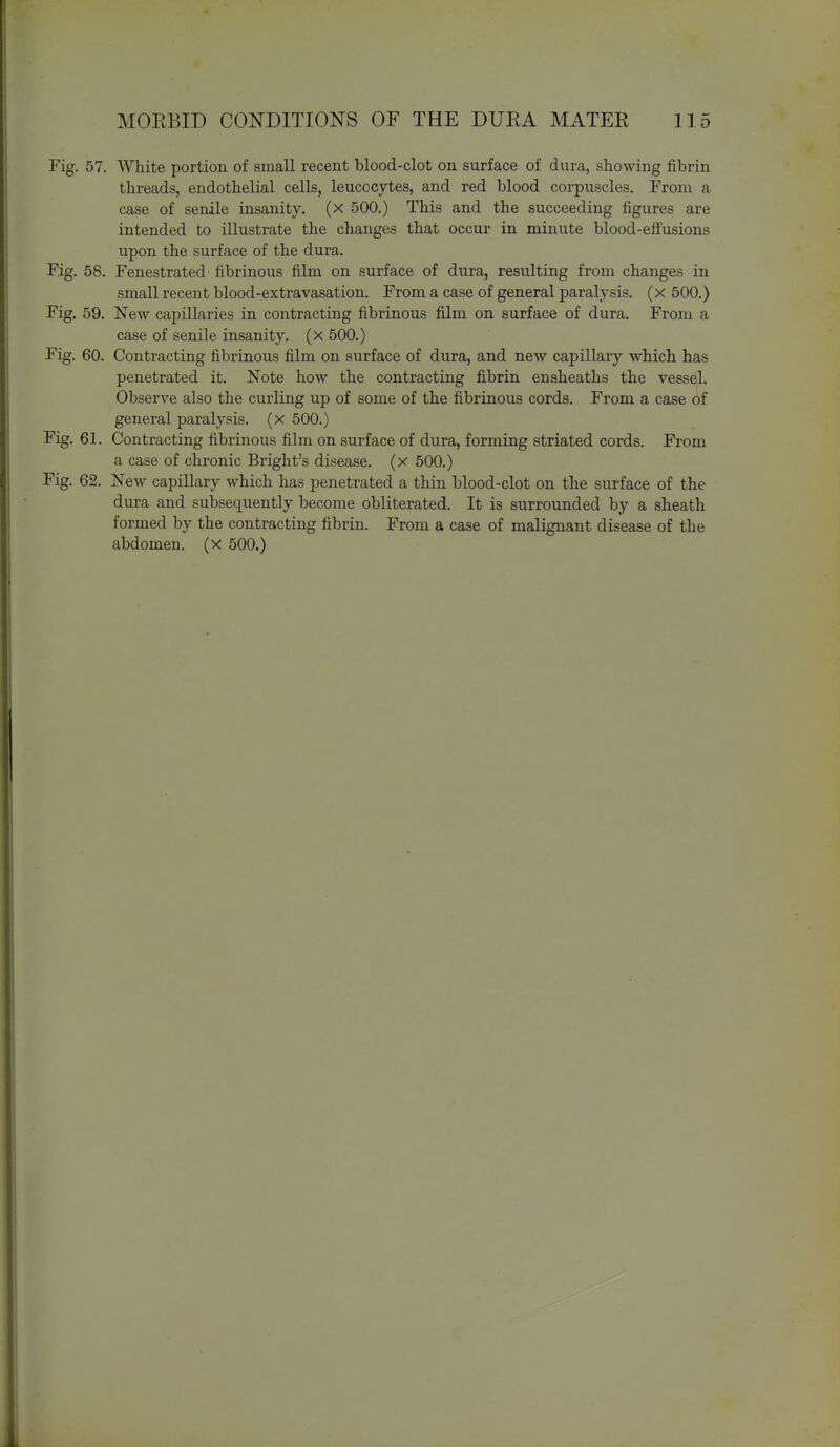 Fig. 57. White portion of small recent blood-clot on surface of dura, showing fibrin threads, endothelial cells, leucocytes, and red blood corpuscles. From a case of senile insanity, (x 500.) This and the succeeding figures are intended to illustrate the changes that occur in miniite blood-effusions upon the surface of the dura. Fig. 58. Fenestrated fibrinous film on surface of dura, resulting from changes in small recent blood-extravasation. From a case of general paralysis, (x 500.) Fig. 59. New capillaries in contracting fibrinous film on surface of dura. From a case of senile insanity, (x 500.) Fig. 60. Contracting fibrinous film on svirface of dura, and new capillary which has penetrated it. Note how the contracting fibrin ensheaths the vessel. Observe also the curling up of some of the fibrinous cords. From a case of general paralysis, (x 500.) Fig. 61. Contracting fibrinous film on surface of dura, forming striated cords. From a case of chronic Bright's disease, (x 500.) Fig. 62. New capillary which has penetrated a thin blood-clot on the surface of the dura and subsequently become obliterated. It is surrounded by a sheath formed by the contracting fibrin. From a case of malignant disease of the abdomen, (x 500.)