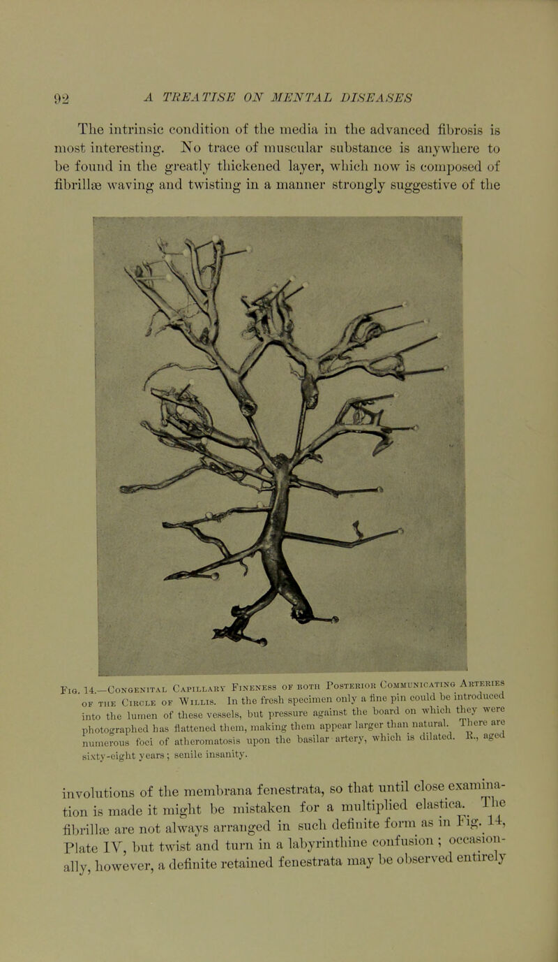 The intrinsic condition of the media in the advanced fibrosis is most interesting. No trace of muscular substance is anywhere to be found in the greatly thickened layer, which now is composed of fibrillae waving and twisting in a manner strongly suggestive of the Fig U-Congenital Capillary Fineness of both Postehiou Comml ni> a i ..nh. Akteries OF THE CiKCLE OF WiLLis. Ill the frcsli Specimen only a iine pin could be introduced into the lumen of these vessels, but pressure against the board on which they were photographed has flattened them, making them appear larger than natural There are numerous foci of atlicromatosis upon the basilar artery, which is dilated. K, aged sixty-eight years; senile insanity. involutions of the membrana f enestrata, so that until close examina- tion is made it might be mistaken for a multiplied elastica.^ The fibrillffi are not always arranged in such definite form as m Fig. 14, Plate lY, but twist and turn in a labyrinthine confusion ; occasion- ally however, a definite retained fenestrata may be observed entirely