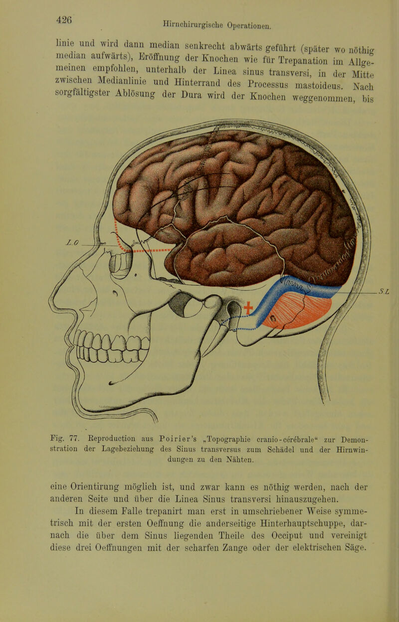 Hirnchirurgiscbe Operationen. linie und wird dann median senkrecht abwärts geführt (später wo nöthk median aufwärts), Eröffnung der Knochen wie für Trepanation im Alke- memen empfohlen, unterhalb der Linea sinus transversi, in der Mitte zwischen Medianlinie und Hinterrand des Processus mastoideus. Nach sorgfaltigster Ablösung der Dura wird der Knochen weggenommen bis .SL Fig. 77. Eeproduction aus Poirier's „Topographie cranio-cerebrale zur Demon- stration der Lagebeziehung des Sinus transversus zum Schädel und der Hirnwin- dungen zu den Nähten. eine Orlentirung möglich ist, und zwar kann es nöthig werden, nach der anderen Seite und über die Linea Sinus transversi hinauszugehen. In diesem Falle trepanirt man erst in umschriebener Weise symme- trisch mit der ersten Oeffnung die anderseitige Hinterhauptschuppe, dar- nach die über dem Sinus liegenden Theile des Occiput und vereinigt diese drei Oeffiiungen mit der scharfen Zange oder der elektrischen Säge.