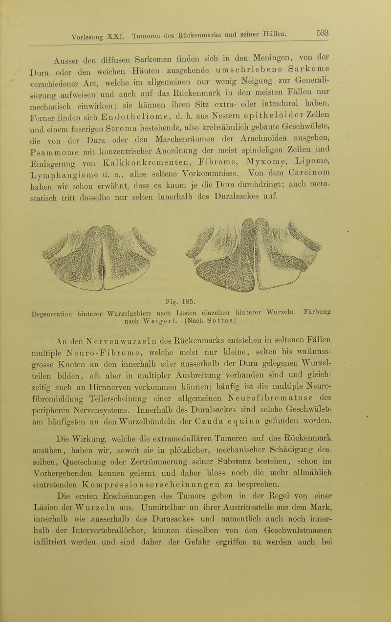 Ausser den diffusen Sarkomen finden sich in den Meningen, von der Dura oder den weichen Häuten ausgehende umschriebene Sarkome verschiedener Art, welche im allgemeinen nur wenig Neigung zur Generali- sierung aufweisen und auch auf das Eilckenmark in den meisten Fällen nur mechanisch einwirken; sie können ihren Sitz extra- oder intradural haben. Ferner finden sich Endotheliome, d. h. aus Nestern epitheloider Zellen und einem faserigen Stroma bestehende, also krebsähnlich gebaute Geschwülste, die von der Dura oder den Maschenräumen der Arachnoidea ausgehen, Psammome mit konzentrischer Anordnung der meist spindeligen Zellen und Einlagerung von Kalkkonkrementen, Fibrome, Myxome, Lipome, Lymphangiome u. a., alles seltene Vorkommnisse. Von dem Carcinom haben wir sclion erwähnt, dass es kaum je die Dura durchdringt; auch meta- statisch tritt dasselbe nur selten innerhalb des Duralsackes auf. ^^^^ Fig. 185. Degeneration liinterer Wurzelgebiete nach Läsion einzelner hinterer Wurzeln. Färbung nach Weigert. (Nach Sottas.) An den Nerven würz ein des Rückenmarks entstehen in seltenen Fällen multiple Neuro-Fibrome, welche meist nur kleine, selten bis wallnuss- grosse Knoten an den innerhalb oder ausserhalb der Dura gelegenen Wurzel- teilen bilden, oft aber in multipler Ausbreitung vorhanden sind mid gleich- zeitig auch an Hirnnerven vorkommen können; häufig ist die multiple Neuro- fibrombildung Teilerscheinung einer allgemeinen Neurofibromatose des peripheren Nervensystems. Innerhalb des Duralsackes sind solche Geschwülste am häufigsten an den Wurzel bündeln der C au da equina gefunden wcden. Die Wirkung, welche die extramedullären Tumoren auf das Rückenmark ausüben, haben wir, soweit sie in plötzlicher, mechanischer Schädigung des- selben, Quetschung oder Zertrümmerung seiner Substanz bestehen, schon im Vorhergehenden kennen gelernt und daher bloss noch die mehr allmählich eintretenden Kompressionserscheinungen zu besprechen. Die ersten Erscheinungen des Tumors gehen in der Regel von einer Läsion der Wurzeln aus. Unmittelbar an ihrer Austrittsstelle aus dem Mark, innerhalb wie ausserhalb des Durasackes und namentlich auch noch inner- halb der Intervertebrallöcher, können dieselben von den Geschwulstmassen infiltriert werden und sind daher der Gefahr ergriffen zu werden auch bei