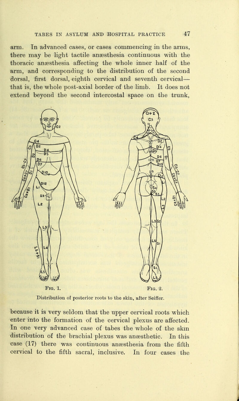 arm. In advanced cases, or cases commenciDg in the arms, there may be hght tactile anaesthesia continuous with the thoracic anaesthesia affecting the whole inner half of the arm, and corresponding to the distribution of the second dorsal, first dorsal, eighth cervical and seventh cervical— that is, the whole post-axial border of the limb. It does not extend beyond the second intercostal space on the trunk, Fig. 1. Fig. 2. Distribution of posterior roots to the skin, after Seiffer. because it is very seldom that the upper cervical roots which enter into the formation of the cervical plexus are affected. In one very advanced case of tabes the whole of the skm distribution of the brachial plexus was anaesthetic. In this case (17) there was continuous anaesthesia from the fifth cervical to the fifth sacral, inclusive. In four cases the