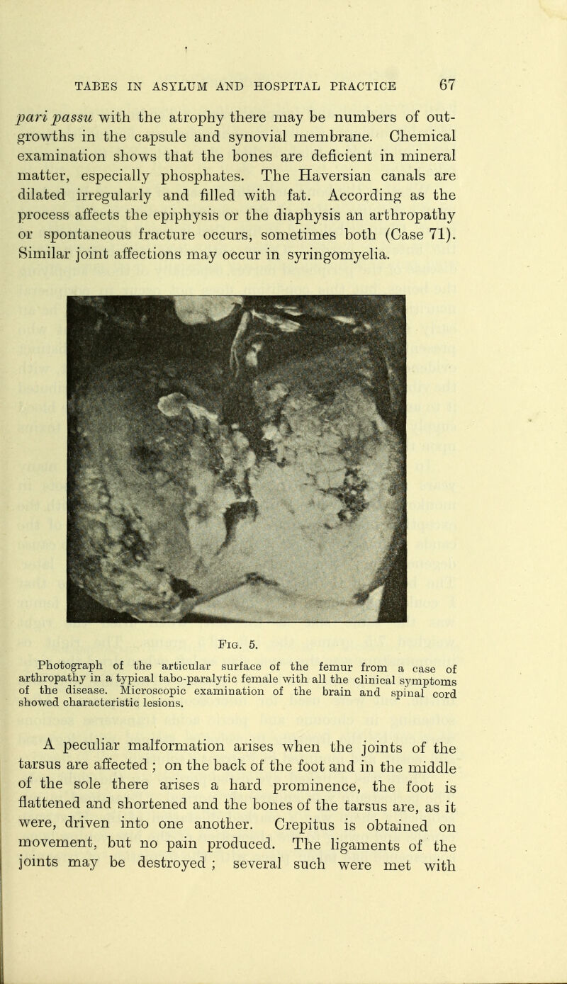 pari passu with the atrophy there may be numbers of out- growths in the capsule and synovial membrane. Chemical examination shows that the bones are deficient in mineral matter, especially phosphates. The Haversian canals are dilated irregularly and filled with fat. According as the process affects the epiphysis or the diaphysis an arthropathy or spontaneous fracture occurs, sometimes both (Case 71). Similar joint affections may occur in syringomyelia. Fig. 5. Photograph of the articular surface of the femur from a case of arthropathy in a typical tabo-paralytic female with all the clinical symptoms of the disease. Microscopic examination of the brain and spinal cord showed characteristic lesions. A pecuhar malformation arises when the joints of the tarsus are affected ; on the back of the foot and in the middle of the sole there arises a hard prominence, the foot is flattened and shortened and the bones of the tarsus are, as it were, driven into one another. Crepitus is obtained on movement, but no pain produced. The ligaments of the jomts may be destroyed ; several such were met with