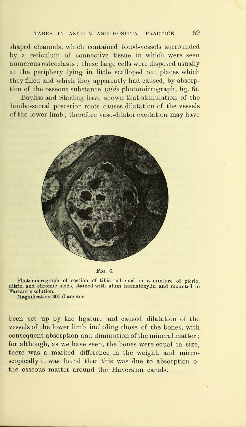 shaped channels, which contained blood-vessels surrounded by a reticulum of connective tissue in which were seen numerous osteoclasts ; these large cells were disposed usually at the periphery lying in little scalloped out places which they filled and which they apparently had caused, by absorp- tion of the osseous substance {vide photomicrograph, fig. 6). Bayliss and Starling have shown that stimulation of the lumbo-sacral posterior roots causes dilatation of the vessels of the lower limb; therefore vaso-dilator excitation may have Fig. 6. Photomicrograph of section of tibia softened in a mixture of picric, nitric, and chromic acids, stained with alum hsematoxylin and mounted in Farrant's solution. Magnification 300 diameter. been set up by the ligature and caused dilatation of the vessels of the lower limb including those of the bones, with consequent absorption and diminution of the mineral matter ; for although, as we have seen, the bones were equal in size, there was a marked difference in the weight, and micro- scopically it was found that this was due to absorption o the osseous matter around the Haversian canals.