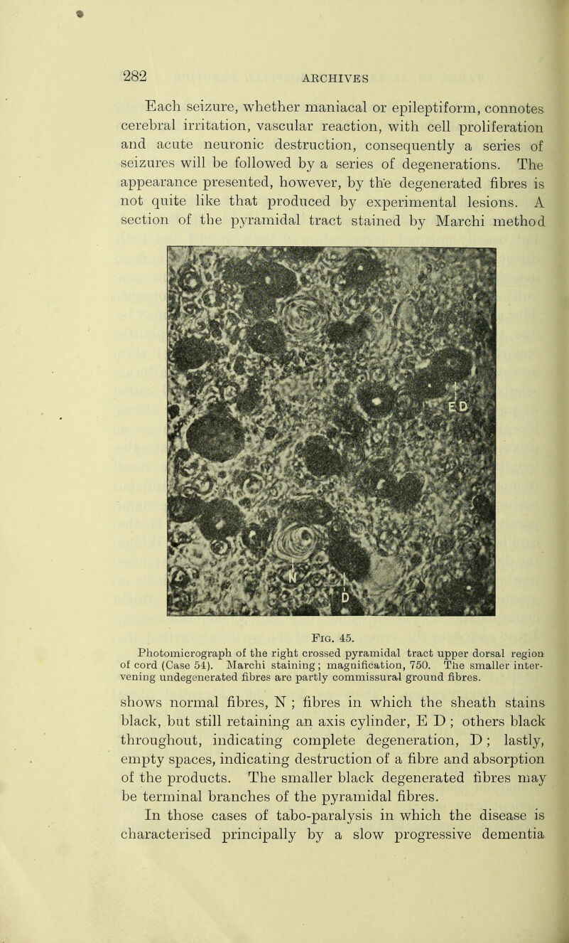 Each seizure, whether maniacal or epileptiform, connotes cerebral irritation, vascular reaction, with cell proHferation and acute neuronic destruction, consequently a series of seizures will be followed by a series of degenerations. The appearance presented, however, by the degenerated fibres is not quite Hke that produced by experimental lesions. A section of the pyramidal tract stained by Marchi method Fig. 45. Photomicrograph of the right crossed pyramidal tract upper dorsal region of cord (Case 54). Marchi staining; magnification, 750. The smaller inter- vening undegenerated fibres are partly commissural ground fibres. shows normal fibres, N ; fibres in which the sheath stains black, but still retaining an axis cylinder, E D ; others black throughout, indicating complete degeneration, D; lastly, empty spaces, indicating destruction of a fibre and absorption of the products. The smaller black degenerated fibres may be terminal branches of the pyramidal fibres. In those cases of tabo-paralysis in which the disease is characterised principally by a slow progressive dementia