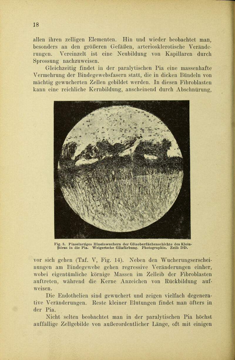 allen ihren zelligen Elementen. Hin und wieder beobachtet man, besonders an den größeren Gefäßen, arteriosklerotische Verände- rungen. Vereinzelt ist eine Neubildung von Kapillaren durch Sprossung nachzuweisen. Gleichzeitig findet in der paralytischen Pia eine massenhafte Vermehrung der Bindegewebsfasern statt, die in dicken Bündeln von mächtig gewucherten Zellen gebildet werden. In diesen Fibroblasten kann eine reichliche Kernbildung, anscheinend durch Abschnürung, Fig. 3. Pinselartiges Hineinwuchern der Gliaoberflächenschichte des Klein- |Mrns in die Pia. Weigertsche Gliafärbung. Photographie. Zeifs DD. vor sich gehen (Taf. V, Fig. 14). Neben den Wucherungserschei- nungen am Bindegewebe gehen regressive Veränderungen einher, wobei eigentümliche körnige Massen im Zelleib der Fibroblasten auftreten, während die Kerne Anzeichen von Eückbildung auf- weisen. Die Endothelien sind gewuchert und zeigen vielfach degenera- tive Veränderungen. Beste kleiner Blutungen findet man öfters in der Pia. Nicht selten beobachtet man in der paralytischen Pia höchst auffällige Zellgebilde von außerordentlicher Länge, oft mit einigen