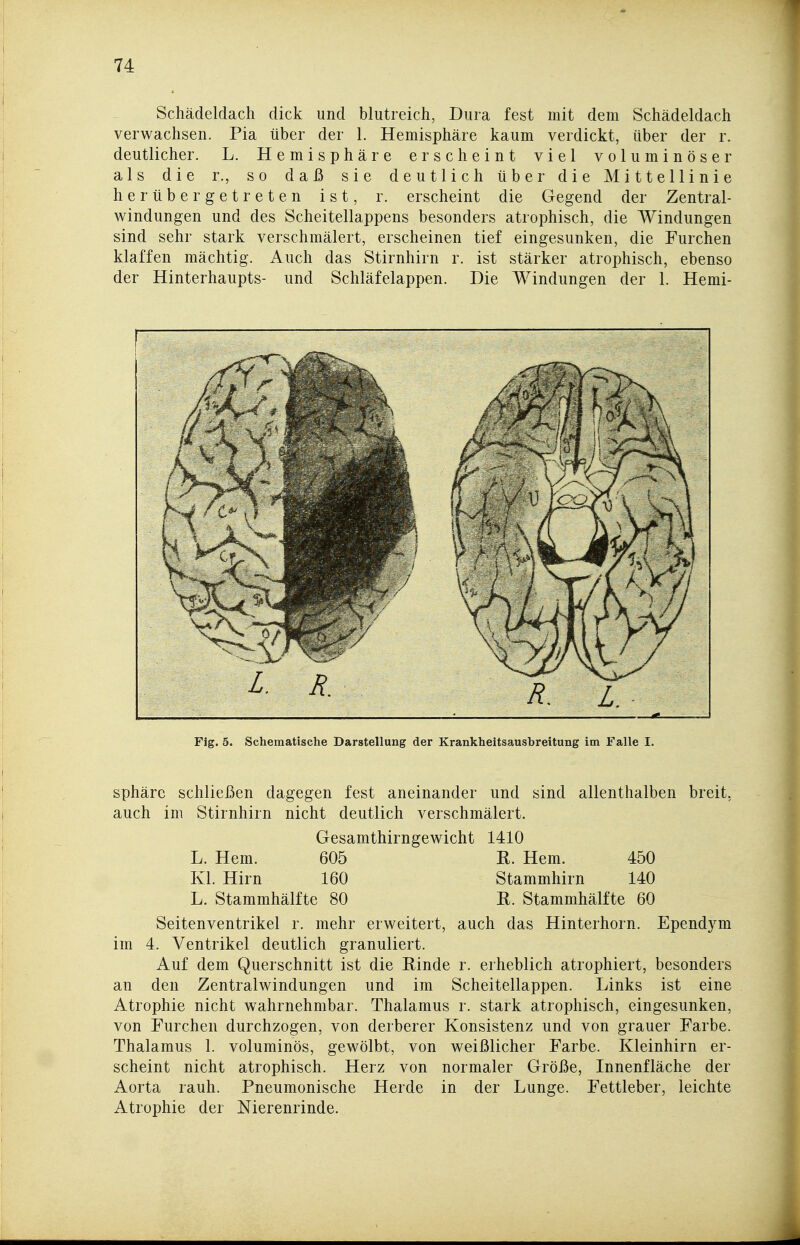 Schädeldach dick und blutreich, Dura fest mit dem Schädeldach verwachsen. Pia über der 1. Hemisphäre kaum verdickt, über der r. deutlicher. L. Hemisphäre erscheint viel voluminöser als die r., so daß sie deutlich über die Mittellinie herübergetreten ist, r. erscheint die Gegend der Zentral- windungen und des Scheitellappens besonders atrophisch, die Windungen sind sehr stark verschmälert, erscheinen tief eingesunken, die Furchen klaffen mächtig. Auch das Stirnhirn r. ist stärker atrophisch, ebenso der Hinterhaupts- und Schläfelappen. Die Windungen der 1. Hemi- Fig. 5. Schematische DarsteUung der Krankheitsausbreitung im FaUe I. Sphäre schließen dagegen fest aneinander und sind allenthalben breit, auch im Stirnhirn nicht deutlich verschmälert. Gesamthirngewicht 1410 L. Hern. 605 R. Hern. 450 Kl. Hirn 160 Stammhirn 140 L. Stammhälfte 80 R. Stammhälfte 60 Seitenventrikel r. mehr erweitert, auch das Hinterhorn. Ependym im 4. Ventrikel deutlich granuliert. Auf dem Querschnitt ist die Rinde r. erheblich atrophiert, besonders an den Zentralwindungen und im Scheitellappen. Links ist eine Atrophie nicht wahrnehmbar. Thalamus r. stark atrophisch, eingesunken, von Furchen durchzogen, von derberer Konsistenz und von grauer Farbe. Thalamus 1. voluminös, gewölbt, von weißlicher Farbe. Kleinhirn er- scheint nicht atrophisch. Herz von normaler Größe, Innenfläche der Aorta rauh. Pneumonische Herde in der Lunge. Fettleber, leichte Atrophie der Nierenrinde.