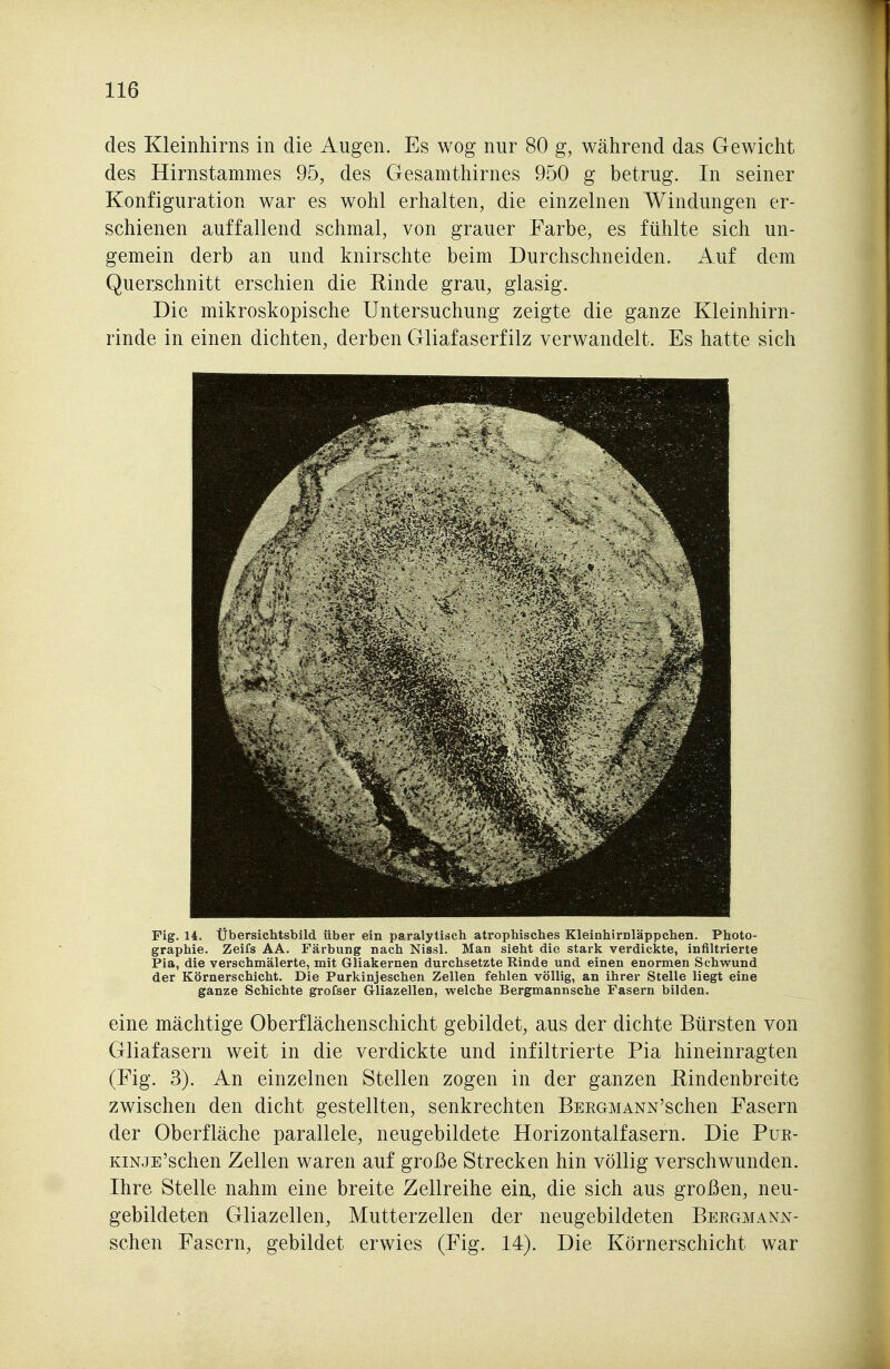 des Kleinhirns in die Augen. Es wog nur 80 g, während das Gewicht des Hirnstammes 95, des Gesamthirnes 950 g betrug. In seiner Konfiguration war es wohl erhalten, die einzelnen Windungen er- schienen auffallend schmal, von grauer Farbe, es fühlte sich un- gemein derb an und knirschte beim Durchschneiden. Auf dem Querschnitt erschien die Rinde grau, glasig. Die mikroskopische Untersuchung zeigte die ganze Kleinhirn- rinde in einen dichten, derben Gliafaserfilz verwandelt. Es hatte sich Fig. 14. Übersichtsbild über ein paralytisch atrophisches Kleinhirnläppchen. Photo- graphie. Zeifs AA. Färbung nach Nissl. Man sieht die stark verdickte, infiltrierte Pia, die verschmälerte, mit Gliakernen durchsetzte Rinde und einen enormen Schwund der Körnerschicht. Die Purkinjeschen Zellen fehlen völlig, an ihrer Stelle liegt eine ganze Schichte grofser Gliazellen, welche Bergmannsche Fasern bilden. eine mächtige Oberflächenschicht gebildet, aus der dichte Bürsten von Gliafasern weit in die verdickte und infiltrierte Pia hineinragten (Fig. 3). An einzelnen Stellen zogen in der ganzen Rindenbreite zwischen den dicht gestellten, senkrechten BERGMANN'schen Fasern der Oberfläche parallele, neugebildete Horizontalfasern. Die Pur- KiNJE'schen Zellen waren auf große Strecken hin völlig verschwunden. Ihre Stelle nahm eine breite Zellreihe ein,, die sich aus großen, neu- gebildeten Gliazellen, Mutterzellen der neugebildeten Beegmann- schen Fasern, gebildet erwies (Fig. 14). Die Körnerschicht war