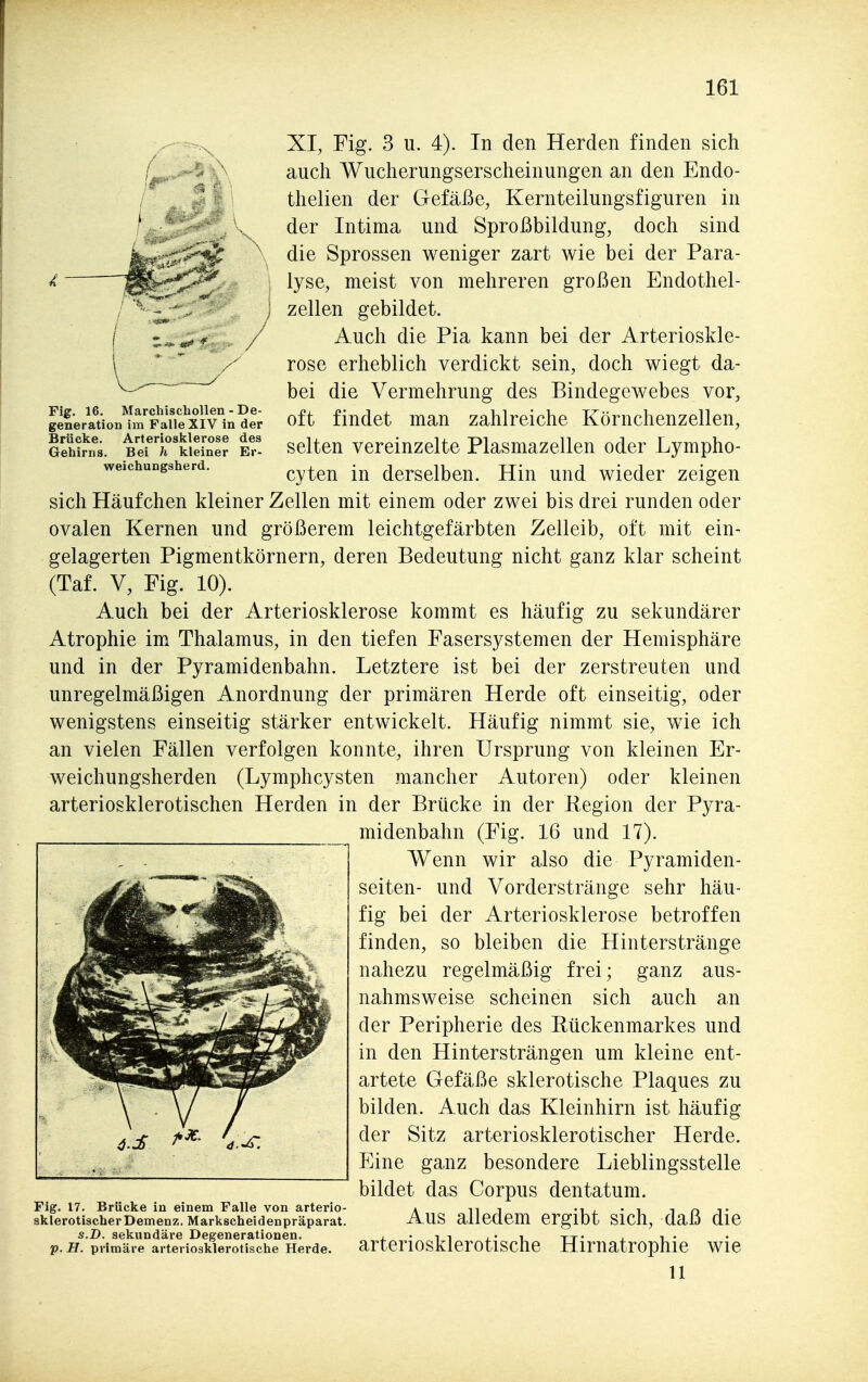 Fig. 16. Marchiscbollen - De- generation im Falle XIV in der Brücke. Arteriosklerose des Gehirns. Bei h kleiner Er- weichungsherd. XI, Fig. 3 u. 4). In den Herden finden sich auch Wucherungserscheinungen an den Endo- thelien der Gefäße, Kernteilungsfiguren in der Intima und Sproßbildung, doch sind die Sprossen weniger zart wie bei der Para- lyse, meist von mehreren großen Endothel- zellen gebildet. Auch die Pia kann bei der Arterioskle- rose erheblich verdickt sein, doch wiegt da- bei die Vermehrung des Bindegewebes vor, oft findet man zahlreiche Körnchenzellen, selten vereinzelte Plasmazellen oder Lympho- cyten in derselben. Hin und wieder zeigen sich Häufchen kleiner Zellen mit einem oder zwei bis drei runden oder ovalen Kernen und größerem leichtgefärbten Zelleib, oft mit ein- gelagerten Pigmentkörnern, deren Bedeutung nicht ganz klar scheint (Taf. V, Fig. 10). Auch bei der Arteriosklerose kommt es häufig zu sekundärer Atrophie im Thalamus, in den tiefen Fasersystemen der Hemisphäre und in der Pyramidenbahn. Letztere ist bei der zerstreuten und unregelmäßigen Anordnung der primären Herde oft einseitig, oder wenigstens einseitig stärker entwickelt. Häufig nimmt sie, wie ich an vielen Fällen verfolgen konnte, ihren Ursprung von kleinen Er- weichungsherden (Lymphcysten mancher Autoren) oder kleinen arteriosklerotischen Herden in der Brücke in der Kegion der Pyra- midenbahn (Fig. 16 und 17). Wenn wir also die Pyramiden- seiten- und Vorderstränge sehr häu- fig bei der Arteriosklerose betroffen finden, so bleiben die Hinterstränge nahezu regelmäßig frei; ganz aus- nahmsweise scheinen sich auch an der Peripherie des Kückenmarkes und in den Hintersträngen um kleine ent- artete Gefäße sklerotische Plaques zu bilden. Auch das Kleinhirn ist häufig der Sitz arteriosklerotischer Herde. Eine ganz besondere Lieblingsstelle bildet das Corpus dentatum. Aus alledem ergibt sich, daß die arteriosklerotische Hirnatrophie wie 11 Fig. 17. Brücke in einem Falle von arterio sklerotischer Demenz. Markscheidenpräparat S.D. sekundäre Degenerationen. %>. H. primäre arteriosklerotische Herde.