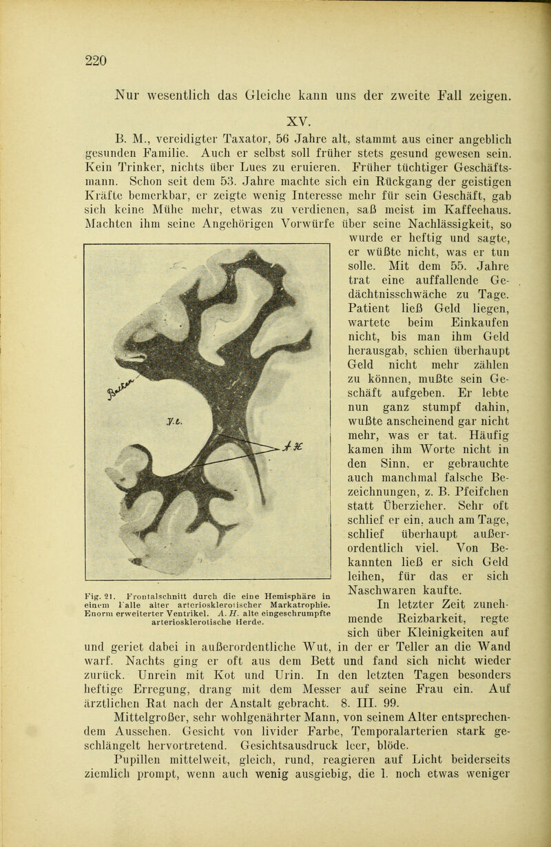 Nur wesentlich das Gleiche kann uns der zweite Pall zeigen. XV. B. M., vereidigter Taxator, 56 Jahre alt, stammt aus einer angeblich gesunden Familie. Auch er selbst soll früher stets gesund gewesen sein. Kein Trinker, nichts über Lues zu eruieren. Früher tüchtiger Geschäfts- mann. Schon seit dem 53. Jahre machte sich ein Rückgang der geistigen Kräfte bemerkbar, er zeigte wenig Interesse mehr für sein Geschäft, gab sich keine Mühe mehr, etwas zu verdienen, saß meist im Kaffeehaus. Machten ihm seine Angehörigen Vorwürfe über seine Nachlässigkeit, so wurde er heftig und sagte, er wüßte nicht, was er tun solle. Mit dem 55. Jahre trat eine auffallende Ge- dächtnisschwäche zu Tage. Patient ließ Geld liegen, wartete beim Einkaufen nicht, bis man ihm Geld herausgab, schien überhaupt Geld nicht mehr zählen zu können, mußte sein Ge- schäft aufgeben. Er lebte nun ganz stumpf dahin, wußte anscheinend gar nicht mehr, was er tat. Häufig kamen ihm Worte nicht in den Sinn, er gebrauchte auch manchmal falsche Be- zeichnungen, z. B. Pfeifchen statt Überzieher. Sehr oft schlief er ein. auch am Tage, schlief überhaupt außer- ordentlich viel. Von Be- kannten ließ er sich Geld leihen, für das er sich Naschwaren kaufte. In letzter Zeit zuneh- mende Reizbarkeit, regte sich über Kleinigkeiten auf und geriet dabei in außerordentliche Wut, in der er Teller an die Wand warf. Nachts ging er oft aus dem Bett und fand sich nicht wieder zurück. Unrein mit Kot und Urin. In den letzten Tagen besonders heftige Erregung, drang mit dem Messer auf seine Frau ein. Auf ärztlichen Rat nach der Anstalt gebracht. 8. III. 99. Mittelgroßer, sehr wohlgenährter Mann, von seinem Alter entsprechen- dem Aussehen. Gesicht von livider Farbe, Temporalarterien stark ge- schlängelt hervortretend. Gesichtsausdruck leer, blöde. Pupillen mittelweit, gleich, rund, reagieren auf Licht beiderseits ziemlich prompt, wenn auch wenig ausgiebig, die 1. noch etwas weniger Fig. 21. FroDtalschnitt durch die eine Hemisphäre in einem lalle alter arteriosklerotischer Markatrophie. Enorm erweiterter Ventrikel. A.H. alte eingeschrumpfte arteriosklerotische Herde.